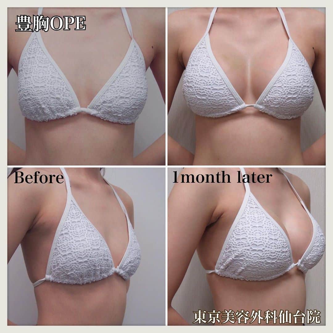 東京美容外科公式のインスタグラム：「👙東京美容外科仙台院です👙 こちらは仙台院院長の加藤Drによる豊胸OPE1ヶ月後の方の症例です✨ まだ若干の内出血もありますが少しずつ引いていきますのでご安心ください☺️ バストアップすると、水着や下着だけでなくお洋服を着た時のシルエットも変わって洋服選びも楽しくなりますよ💖 ・ バストのお悩みがある方、一度ご相談してみませんか？ サイズや施術方法も含めて、ドクターが皆様のお悩みに合わせてカウンセリング致しますのでぜひご相談下さい💁🏻‍♀️✨ ・ 🌷ウルトラセルQプラス ¥70,000(初回) 🌷ヴェルベットスキン ¥45,000(初回）  ・ その他メニュー各種ございます😊💕 お気軽にお問い合わせくださいませ🍏🍎 各線「仙台駅」より徒歩5分、JR仙石線「あおば通駅」より徒歩2分 ♡ 東京美容外科 仙台院にぜひお越しください！😇 . . ====🎁お問い合わせはこちら🎁==== 詳しくはプロフィールのURLから公式サイトへ♪ ▼フリーダイヤル 0120-658-958 （コールセンター受付時間：9：00～21：00） ▼LINE予約 @ tkc110 ========================= . #東京美容外科 #東京美容外科仙台院 #仙台 #宮城 #美容 #美容整形 #整形 #美活 #綺麗になりたい #美肌 #美意識  #美容外科 #プチ整形 #エイジングケア #アンチエイジング #美容好き #韓国美容 #美容整形外科 #ヒアルロン酸 #鼻整形 #二重 #埋没 #埋没法 #豊胸 #豊胸手術 #バストアップ #バスト #webカウンセリング始めました #東美東北胸」