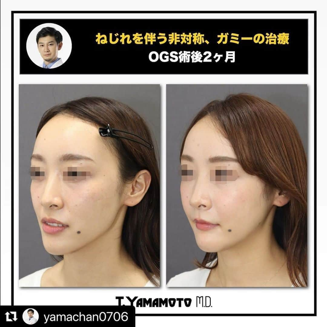 東京美容外科公式さんのインスタグラム写真 - (東京美容外科公式Instagram)「東京美容外科・赤坂副院長の骨切り山ちゃんの症例のご紹介です🥰✨ #Repost @yamachan0706 with @make_repost ・・・ ★★★ねじれを伴う複雑な非対称とガミースマイルを同時に治すOGS術後２ヶ月★★★ ★ダウンタイムが落ち着いてくると次にやるべきことが見えてくる★  以前投稿した非対称とガミーの患者様の術後経過になります。 ２ヶ月たち腫れが落ち着いてきました。 もともと美人さんでしたが、更にとても洗練された美人さんになり、なんだか印象もとても明るくなった気がします。 少し長めのお顔をガミースマイルの改善と同時に治療しています。  さて、 腫れが落ち着くと、もともと長かった左側のお顔のほうが、より圧縮されるわけなので、左側のほうがお肉が余ったりしやすいです。  この患者さんも左頬がやはり右よりふっくらしますよね。  こういう左右差には、脂肪の量の調整（Buccal fatや脂肪吸引、注入）やエラボトックスなんかが効果的です。  まずは半年、お肉が骨にフィットするまでは経過を見ていきたいと思います。フィットを早めるためにHIFUなどもおすすめです。  このような捻じれのある非対称の患者様は極めて3次元的に高度な骨移動の仕方になるため、３Dシミュレーションでの綿密な計画をたててくれるところでしか手術を行うべきです。 我々は、３Dシミュレーションで作成したデータを元に３Dプリンターで作成したマウスピースを用いることで実際の手術を正確に行えるような工夫を行っています。  非対称にお悩みの方は、お力になれるかもしれません。 是非一度ご相談ください。  /////////////////////////////////////////////////////////////////////////////////////////////////////  カウンセリングは東京美容外科のコールセンター、LINE予約などから受け付けております。 また、Webカウンセリングなどもぜひご利用ください。  /////////////////////////////////////////////////////////////////////////////////////////////////////  /////////////////////////////////////////////////////////////////////////////////////////////////////  ＜行った施術＞ Le Fort Ⅰ型骨切り＋SSRO+＋オトガイ形成（短縮、左方移動）＋Vライン形成  ＜リスク＞ 下口唇の痺れ プレート感染 後戻り 血腫、後出血 鼻閉 開口制限 咬合不正など  /////////////////////////////////////////////////////////////////////////////////////////////////////  #整形美人 #小顔美人 #小顔整形 #顔痩せ #外科矯正 #受け口 #下顎前突 #口元美人 #顎変形症 #ルフォー #lefort #顔面非対称 #輪郭手術 #輪郭整形 #整形垢さんと繋がりたい #美容垢さんと繋がりたい #両顎手術 #形成外科専門医 #骨切り山ちゃん #小顔になりたい #小顔美容矯正 #顔でかい #顔でか #顔やせ #eライン #整形したい #横顔美人 #横顔フェチ #顔の歪み」9月21日 21時55分 - tokyobiyougeka_jimukyoku