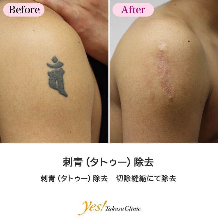 高須クリニックのインスタグラム：「👨🏻‍⚕️高須幹弥医師からのコメント✨⠀ 抜糸直後の状態。腫れは引きましたが、皮膚の盛り上がりや赤みがあります。この手術による傷跡は、6ヶ月~1年でかなり目立たなくなっていきます。 ---------------------------------------------------- 🌈料金✨⠀ ●刺青（タトゥー）除去（レーザー） 1cm×1cm ¥10,000 / 線状の入れ墨の場合　1cm ¥10,000【全院】 ●刺青（タトゥー）除去（切除縫縮） 顔面以外の入れ墨を単純に縫合する場合の目安　1cm ¥25,000【東京、横浜、名古屋、大阪】 ※また、単純に直線で縫合するのではなく、複雑な手術になる場合は料金が割増になります。 ●刺青（タトゥー）除去（剥削） ハガキ大サイズ ¥500,000【東京、横浜、名古屋、大阪】 ●刺青（タトゥー）除去（皮膚移植） ハガキ大サイズ ¥600,000【東京、横浜、名古屋、大阪】 ---------------------------------------------------- ⚠️リスク・副作用・合併症✨⠀ ●刺青（タトゥー）除去 完全に除去しきれない（黒や青以外の入れ墨の場合） 手術後に処方する抗生剤や痛みどめによるアレルギー症状 傷跡が肥厚性瘢痕やケロイドになる可能性（切除縫縮手術） 傷跡が肥厚性瘢痕やケロイドになる可能性（剥削手術） 手術後の血腫 --------------------------------------------------- 😊施術についての詳細✨⠀⠀ https://www.takasu.co.jp/photo/irezumi11.html ---------------------------------------------------- 📞ご予約・お問い合わせ✨⠀ 0120-5587-10⠀ https://www.takasu.co.jp/cgi-bin/form/contact.cgi ※症例写真や施術に関するご質問なども上記までお願い致します。 ---------------------------------------------------- #タトゥー #入れ墨 #刺青 #タトゥー除去 #入れ墨除去 #刺青除去 #タトゥーを消したい #タトゥー消したい #タトゥー消す #皮膚 #美容 #美肌 #エイジングケア #美容整形 #美容外科 #美容クリニック #美容好き #美容皮膚科 #モニター #モニター募集 #高須クリニック #高須クリニック名古屋 #高須幹弥 #整形したい #プチ整形 #症例 #症例写真 #可愛くなりたい #可愛い #美人」