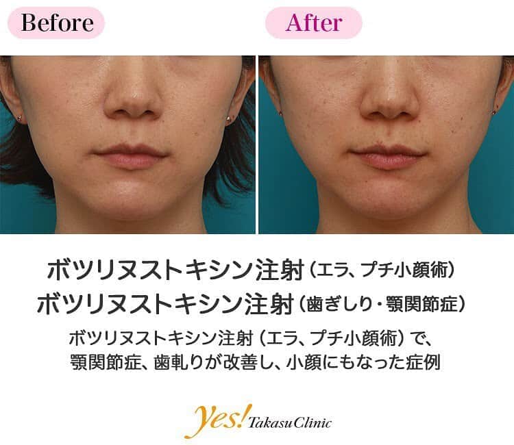 高須クリニックのインスタグラム：「👨🏻‍⚕️高須幹弥医師からのコメント✨⠀ 20代女性の患者様で、顎関節症があり、歯軋りをすることが悩みとのことでした。 診察させていただいたところ、エラの部分の咬む筋肉（咬筋）が発達しており、顔の下半分の横幅が大きくなっていました。 患者様に、ボツリヌストキシン注射をして、咬筋を萎縮させると、顎関節症の症状や歯軋りが改善し、尚且つ小顔効果もあると説明させていただいたところ、「是非やってみたい」とのことでした。 咬筋の最も肥大している部分を中心にボツリヌストキシンを注射したところ、2~4週間かけて、萎縮していき、すっきりとした小顔になりました。 また、咬筋の緊張がとれたことにより、顎関節の症状や歯軋りもかなり改善しました。 ---------------------------------------------------- 🌈料金✨⠀ ●ボツリヌストキシン注射（エラ、プチ小顔術） 1回 ¥150,000【全院】 ●ボツリヌストキシン注射（歯ぎしり・顎関節症） 1回 ¥150,000【東京、横浜、名古屋、大阪】 ---------------------------------------------------- ⚠️リスク・副作用・合併症✨⠀ ●ボツリヌストキシン注射（エラ、プチ小顔術） 内出血（注射針が血管に当たってしまった場合） 妊活・妊娠・授乳中の方への施術不可 仕上がりのわずかな左右差（完璧なシンメトリーは不可） 一時的に噛む力が弱く感じる ●ボツリヌストキシン注射（歯ぎしり・顎関節症） 内出血（注射針が血管に当たってしまった場合） 妊活・妊娠・授乳中の方への施術不可 --------------------------------------------------- 😊施術についての詳細✨⠀⠀ https://www.takasu.co.jp/photo/botox17.html ---------------------------------------------------- 📞ご予約・お問い合わせ✨⠀ 0120-5587-10⠀ https://www.takasu.co.jp/cgi-bin/form/contact.cgi ※症例写真や施術に関するご質問なども上記までお願い致します。 ---------------------------------------------------- #ボツリヌストキシン注射 #エラ #プチ小顔術 #歯ぎしり #顎関節症 #小顔効果 #皮膚 #美容 #美肌 #エイジングケア #美容整形 #美容外科 #美容クリニック #美容好き #美容皮膚科 #モニター #モニター募集 #高須クリニック #高須クリニック名古屋 #高須幹弥 #整形したい #プチ整形 #症例 #症例写真 #可愛くなりたい #可愛い #美人」