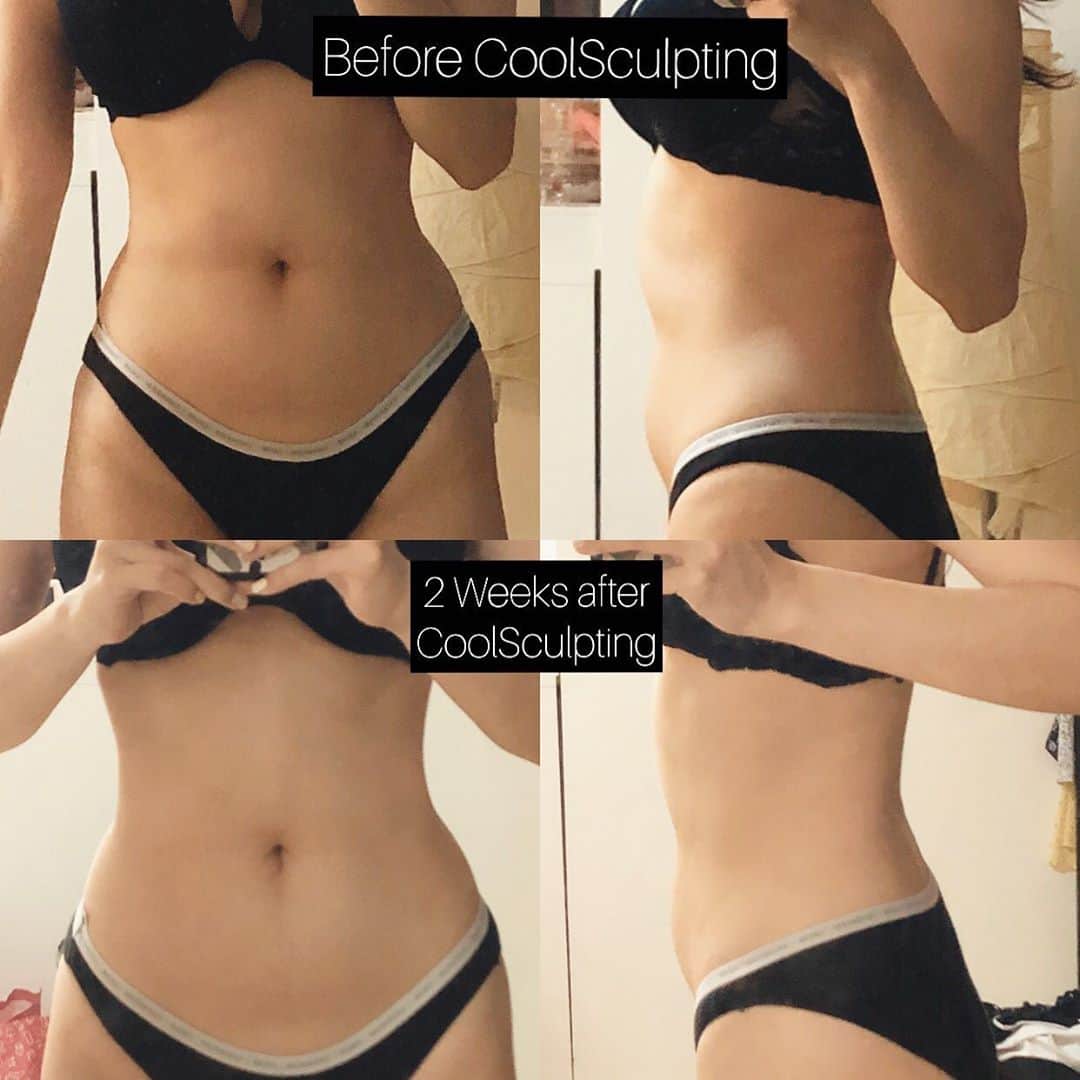 YingTzeさんのインスタグラム写真 - (YingTzeInstagram)「I bought this two piece swimsuit from H&M few years ago and finally I can wear it. 😂 _ My #coolsculpting progress on my abdomen after 2 weeks. ( swipe left for before after photo ). ❤️ I’m so happy that just with one session , @sliqclinic has solved the insecurity that I had for many years. I have one more session for my abdomen and two more for my thighs. 😤✨ _ p/s : for the full story check out my IG Story Highlights ❤️ #blessed #coolsculptingbeforeandafter #coolsculptingresults #sliqclinic」9月24日 9時47分 - yingtze