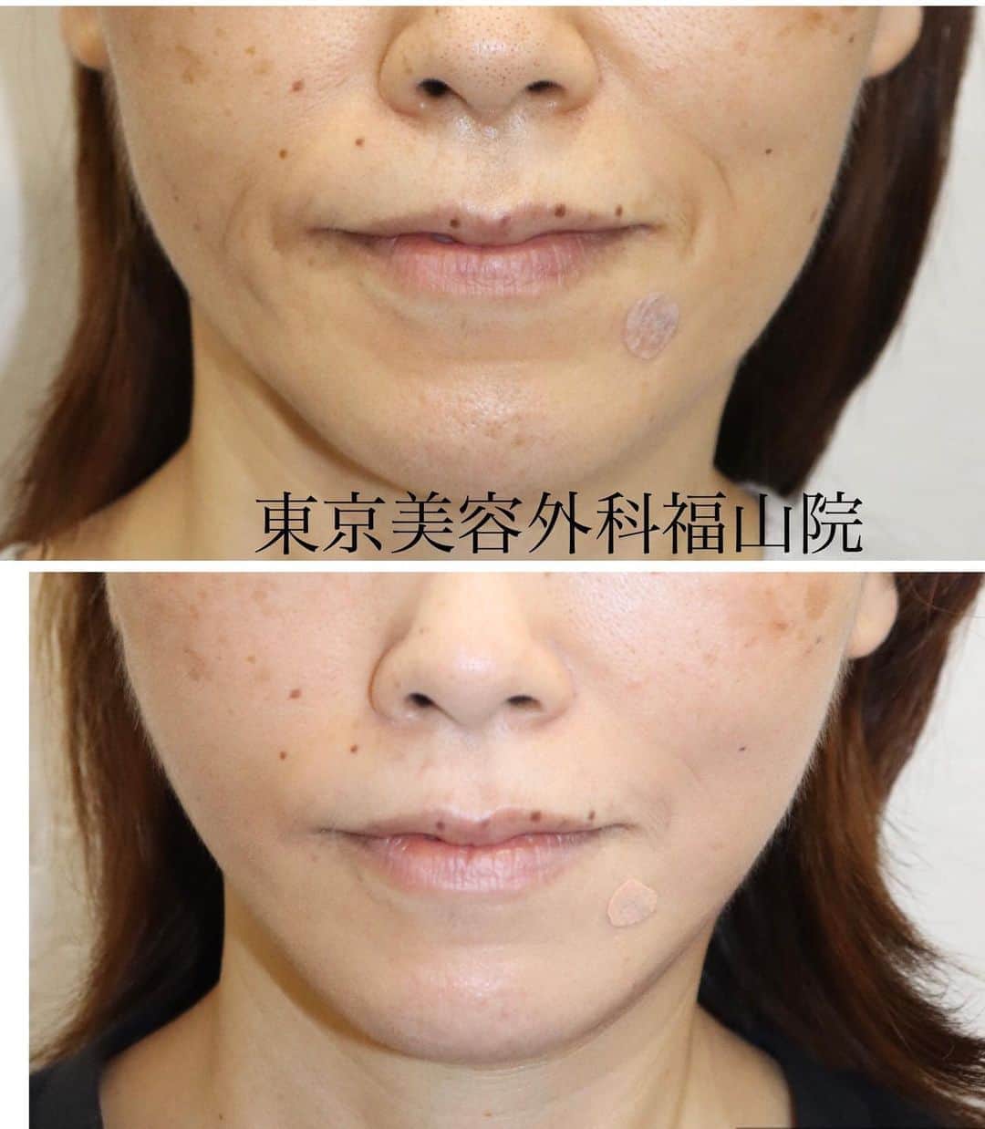 東京美容外科公式のインスタグラム：「こんにちは✨ 🌹東京美容外科福山院です🌹 . 【切らないフェイスリフト治療でたるみ改善✨】 . 自然にリフトアップが可能な オルチャンリフト💁‍♀️ リフトアップ効果でほうれい線の シワも改善されてますね🥰 ※個人差がございます . 糸の先端についたアンカーで引き上げ状態を持続🧚‍♀️ . 糸の周辺でコラーゲンの生成も起こり肌にハリツヤも与えてくれます🥰 . オルチャンリフト 💰¥10,000〜（両側1本ずつ） リスク⚠️内出血、腫れ、左右差 . しっかりリフトアップされるなら 両側3本ずつ以上がオススメ✨✨ . まずはお気軽にご相談を😊 . 詳しくはお問い合わせください🥰 . 【東京美容外科】 ====□お問い合わせはこちら□===== ▼フリーダイヤル ☎0120-658-958 （コールセンター受付時間：9：00～21：00） . ▼LINE予約 @ tkc110 ============== #東京美容外科#福山#オルチャンリフト#ニキビ肌#汗管腫#綺麗#beautiful#二重#プチ#kawaii#コンプレックス #アイプチ#卒業#キャンペーン#モデル#モニター#目力#美容#美意識#女子力#可愛い#美白ケア#唇#プルプル#ラシャスリップス #美容クリニック」