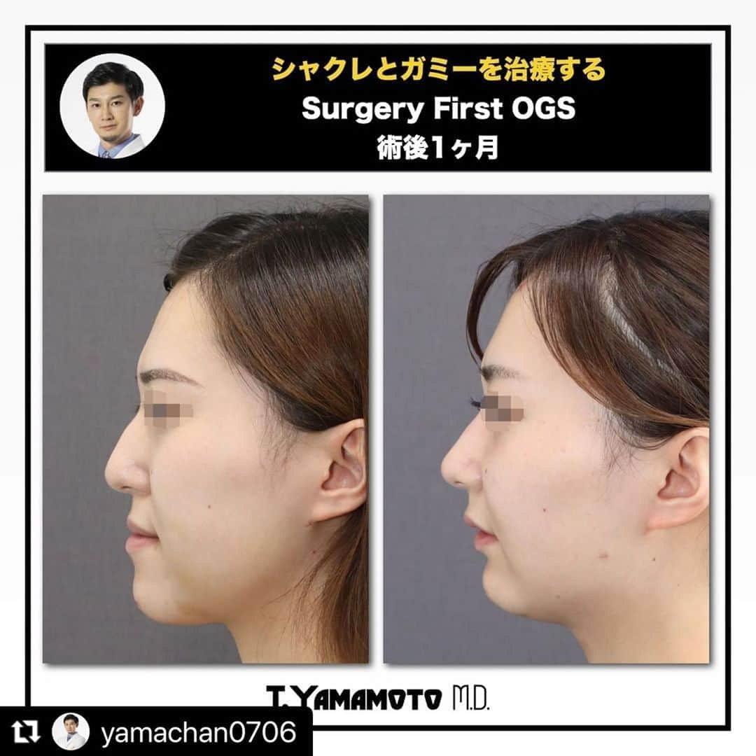 東京美容外科公式さんのインスタグラム写真 - (東京美容外科公式Instagram)「#Repost @yamachan0706 with @make_repost ・・・ ★★★シャクレとガミーを一気に治療するSurgery First OGS　術後1ヶ月★★★ ★知っていましたか？シャクレとガミースマイルは伸びしろの塊だということを★  先回もレポートさせてもらったモニター患者様の1ヶ月の経過です。 遠方から毎回検診にきていただきありがたい限りです。  ガミースマイルとシャクレを併発している方は、コンボで顔がとっても小顔になり別人になります。 だいたい、久々に会った人に気づかれないのはこのタイプの方です。 ガミーとシャクレがコンプレックスのあなた、実はとんでもない伸びしろの持ち主かもしれませんよ。  この患者様、とてもメンタルが健康的な方で、術後２−3週間でマスクなしで普通に接客のお仕事をされていたそうです。 こういう方に特徴的なのが、折れない心。 個人的な印象としては、腫れが引きやすい、口の開きが良くなりやすい、口周りの筋肉の回復が早く自然な笑顔が早期から見られる。 など、特徴的な良好な経過をたどります。  なのでメンタルとても大切です・・・  色々と不安に思ってしまう方は、とにかく悩んでも仕方ないことと本当に悩むべきことは切り離しましょう。 例えば、術前色々と不安なことは多いと思いますが、いくら不安に思っても執刀医のプランというのは決まったものからほとんど変化はありませんし、不安に感じるだけ無駄な部分があります。 決めたものは決めたもので覚悟を決めることもときには大切です。  それでももやもや不安に思ってしまう気持ちとってもよくわかります。 そういう方はとても気遣いができて、人にやさしく繊細な方が多いです。 けれども、自分を追い込んでしまう不安は切り離しましょう。  瞑想やマインドフルネスなんかを取り入れてもいいですし、緑の多いところにお散歩にいくでもよし、 大好きな趣味などに熱中するでもよし、お風呂上がりにアイスクリームを味に集中しながら食べるのもよし。 とにかく、手術前にモヤモヤ、あれやこれやとりとめもなく考えてしまうことだけはやめましょう。 精神が疲れてしまいます。  執刀医は、患者さんがどんな精神状態でも安定してプランをたてていますし、可愛くなるために手術を受けるのですから前向きな気持ちで手術に挑まれてくださいね。 不安なときはサポートさせていただきますので、頑張って乗り切りましょう。  /////////////////////////////////////////////////////////////////////////////////////////////////////  カウンセリングは東京美容外科のコールセンター、LINE予約などから受け付けております。 また、Webカウンセリングなどもぜひご利用ください。  /////////////////////////////////////////////////////////////////////////////////////////////////////  /////////////////////////////////////////////////////////////////////////////////////////////////////  ＜行った施術＞ Le Fort Ⅰ型骨切り＋SSRO  ＜リスク＞ 下口唇の痺れ プレート感染 咬合不正 後戻り 血腫、後出血 鼻閉 開口制限 骨折など  /////////////////////////////////////////////////////////////////////////////////////////////////////  #整形美人 #小顔美人 #顔痩せ #外科矯正 #受け口 #下顎前突 #口元美人 #顎変形症 #ルフォー #lefort #顔面非対称 #輪郭手術 #輪郭整形 #整形垢さんと繋がりたい #美容垢さんと繋がりたい #両顎手術 #形成外科専門医 #骨切り山ちゃん #小顔になりたい #小顔美容矯正 #顔でかい #顔でか #顔やせ #eライン #eline #整形したい #横顔美人 #横顔フェチ #顔の歪み」9月24日 20時47分 - tokyobiyougeka_jimukyoku