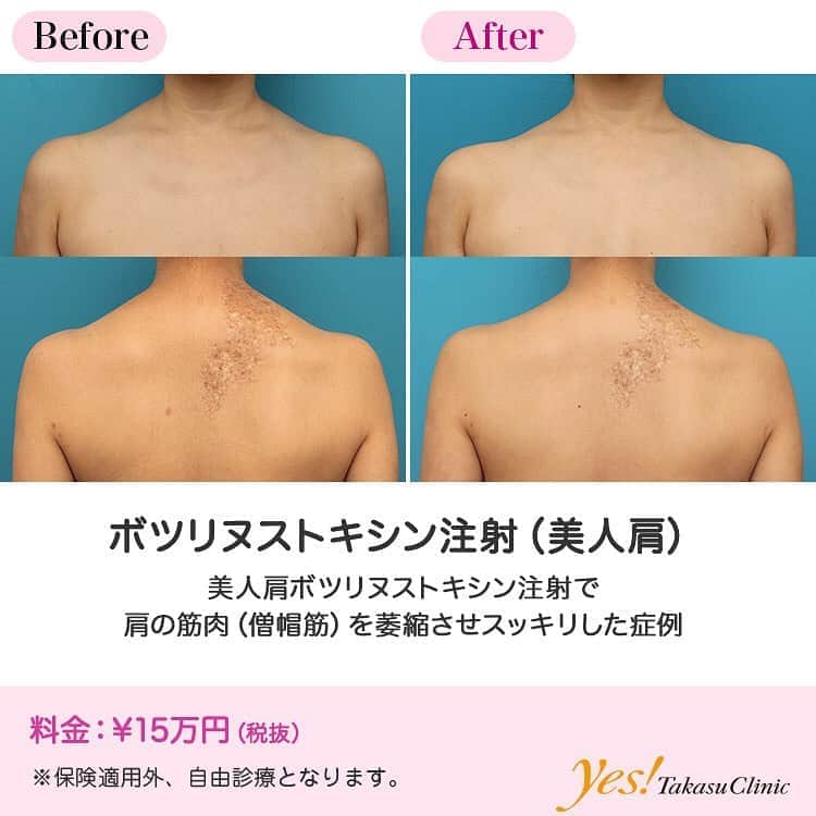 高須クリニックのインスタグラム：「👨🏻‍⚕️高須幹弥医師からのコメント✨⠀ 40代女性の患者様で、肩の筋肉が発達し、いかつくなっているのが悩みとのことでした。 診察させていただいたところ、全体的に僧帽筋が発達しており、女性にしてはゴツゴツした印象がありました。 特に僧帽筋の上部が発達しており、なで肩になっていました。 僧帽筋の上部にボツリヌストキシンを注射し、なで肩をすっきりさせることになりました。 治療は、注射部位に麻酔クリームを塗ったあと、上部の僧帽筋に満遍なくボツリヌストキシンを注入しました。 注射して2ヶ月後には程よく僧帽筋の上部が萎縮しました。 また、なで肩も改善し、すっきりした肩のラインになりました。 ---------------------------------------------------- 🌈料金✨⠀ ●ボツリヌストキシン注射（美人肩） ¥150,000【全院】 ---------------------------------------------------- ⚠️リスク・副作用・合併症✨⠀ ●ボツリヌストキシン注射（美人肩） 内出血（注射針が血管に当たってしまった場合） 妊活・妊娠・授乳中の方への施術不可 --------------------------------------------------- 😊施術についての詳細✨⠀⠀ https://www.takasu.co.jp/photo/beautiful_shoulder_botox004.html ---------------------------------------------------- 📞ご予約・お問い合わせ✨⠀ 0120-5587-10⠀ https://www.takasu.co.jp/cgi-bin/form/contact.cgi ※症例写真や施術に関するご質問なども上記までお願い致します。 ---------------------------------------------------- #ボツリヌストキシン注射 #美人肩 #なで肩改善 #すっきりした肩のライン  #皮膚 #美容 #美肌 #エイジングケア #美容整形 #美容外科 #美容クリニック #美容好き #美容皮膚科 #モニター #モニター募集 #高須クリニック #高須クリニック名古屋 #高須幹弥 #整形したい #プチ整形 #症例 #症例写真 #可愛くなりたい #可愛い #美人」