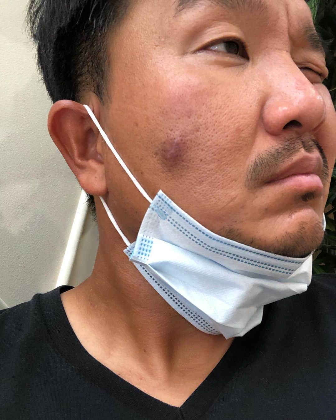 大西宏明のインスタグラム：「人生3度目の手術‼️  お父さん お母さんゴメンなさい…今回は思い切って顔面🤐  くっきり二重！パッチリオメメとは正反対なヌットリ一重😑  スペイン🇪🇸なら きっと1番低いであろう鼻👃  その他 言い出したらキリがなく色々なパーツにドロップキックしたい気持ちなんで🐾 今回はその全てを‼️‼️‼️‼️  スルーして………  春先からホッペにできてたデキモノの切除でした😂  手術✂️っ言葉に色々とご心配をおかけしました✨  デキモノ切っただけかよ！！です😁  でもガッツリ しっかり１時間 なかなかな手術で痛々しいフェイスです🔪  少しは男前になったかな⁉️🥺  さてお見舞い 笑ぎゅうでお待ちしてます🙇‍♂️  #超絶ブス #脱却 #新しい #自分 #過去の自分 #さよなら (*≧∀≦*) #人生3度目 #手術 #顔面国宝  #お見舞い #お待ちしてます #お肉好き #smile #ほなっ！！」