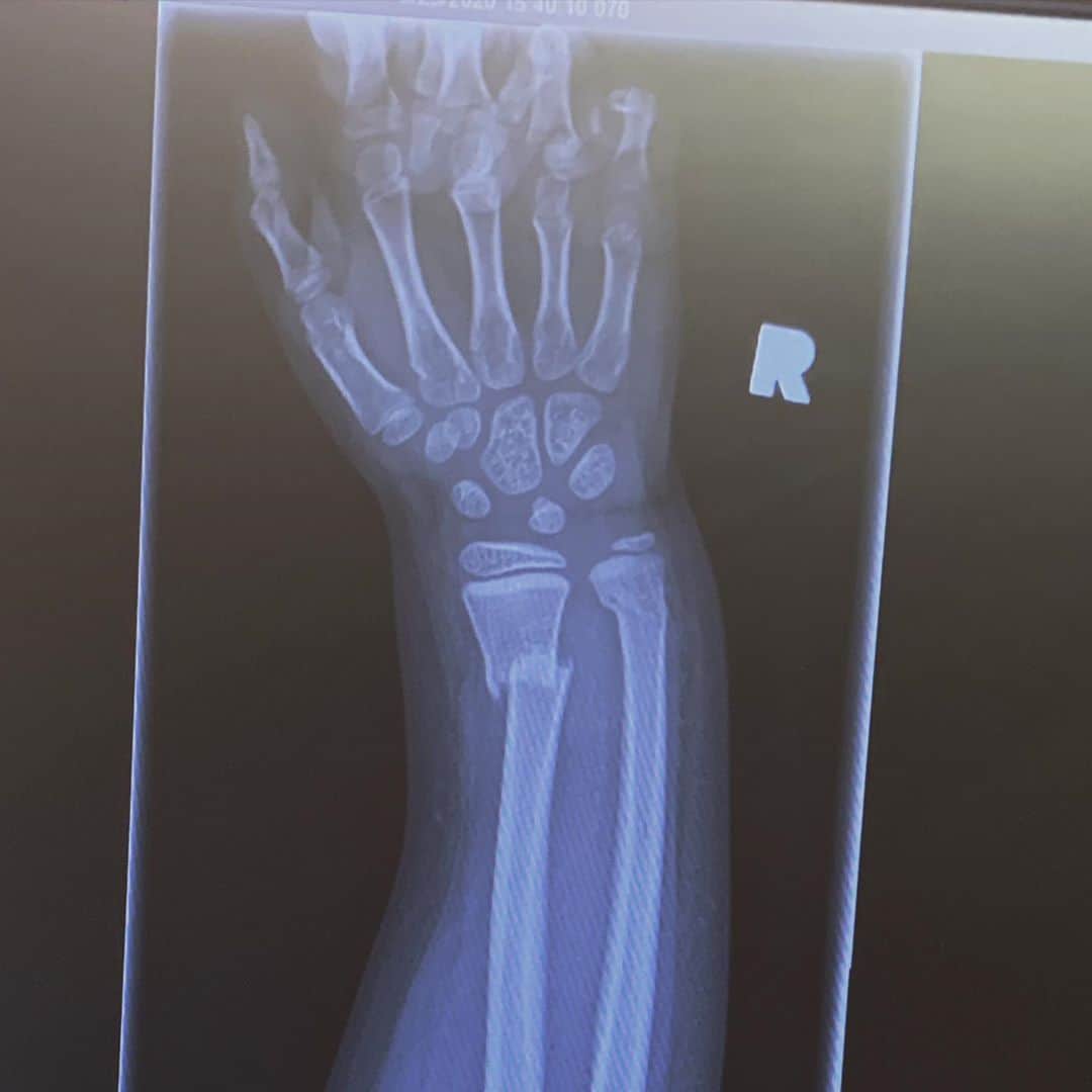 カーキ・キングのインスタグラム：「Friday night in the ER. This is my daughter's arm, not mine, but I would take on that pain in a second if it would have spared her those hours of agony. This was a summer of skateboarding, learning to ride a bike, and hiking over fallen trees and boulders. In the end it was just a barely missed jump to the monkey bars that was her undoing. She has a cool cast and a box of sharpies for her friends to sign it with. We forge on. Watch out monkey bars--this girl fights back.」