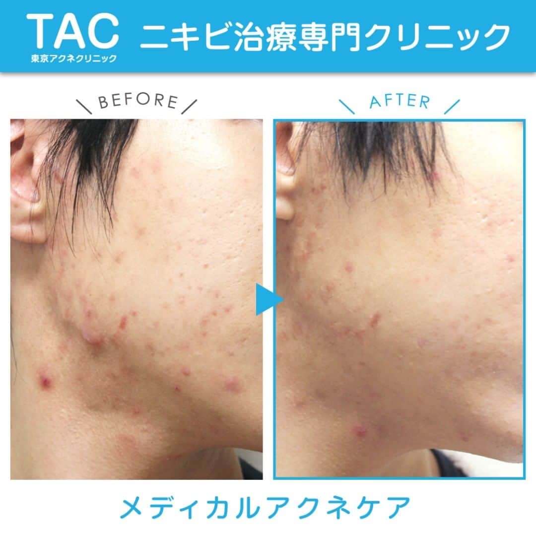 東京アクネクリニックさんのインスタグラム写真 - (東京アクネクリニックInstagram)「急増中！顎ニキビ  長期間のマスク着用で顎ニキビができる方急増中  当院のメディカルアクネケアは、ニキビができる原因となる「皮脂腺」一つ一つに微細な針を挿入し通電することで﻿ ダイレクトに異常皮脂腺を破壊します⚡️﻿ ﻿  ニキビの原因を排除して、もうニキビに悩むことのない肌を目指しましょう😇💚﻿ ﻿ ✔️繰り返すニキビにお悩みの方は﻿ 「東京アクネクリニック」までお気軽にご相談ください。﻿ ﻿ +:-:+:-:+:-:+:-:+:-:+:-:+:-:+:-:+:-:+﻿ ﻿ 症例写真　20代男性﻿ 【治療メニュー】﻿ メディカルアクネケア5回、ピーリング5回 コスメ　セルニュー使用  ﻿ +:-:+:-:+:-:+:-:+:-:+:-:+:-:+:-:+:-:+﻿ 【料金】﻿ メディカルアクネケア﻿ 鼻、鼻下[各1箇所] 20,000円﻿ 額全体、首、顎ライン[各1箇所]　40,000円﻿ ﻿ アクネピーリング　セット1回　30,000円﻿ +:-:+:-:+:-:+:-:+:-:+:-:+:-:+:-:+:-:+﻿ ﻿ 🔹東京アクネクリニック🔹﻿ ﻿ 📲フリーダイヤル　0120-90-5541﻿ ※コールセンター受付時間 9:00～21：00﻿ ﻿ お問い合わせはプロフィールのURLから👆🏻﻿ +:-:+:-:+:-:+:-:+:-:+:-:+:-:+:-:+:-:+﻿ ﻿ #ニキビ #大人ニキビ #吹き出物 #ニキビ跡 #ニキビ肌改善 #ニキビ治療 #肌荒れ #ニキビケア #ニキビ改善 #肌荒れ改善 #美肌治療 #美肌 #美肌ケア #美容皮膚科 #皮膚科 #エステ #ピーリング #肌質改善 #すっぴん #スキンケア #ニキビ予防 #メディカルアクネケア﻿ #赤ニキビ　#黒ニキビ　#黄ニキビ﻿ #ニキビ治療専門 #アクネピーリング  #アクネクリニック症例」9月28日 17時31分 - nikibi.c