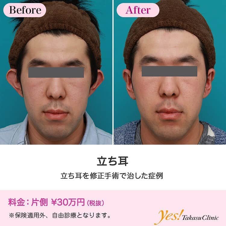 高須クリニックのインスタグラム：「👨🏻‍⚕️高須幹弥医師からのコメント✨⠀ 30代男性の患者様で、立ち耳を治したいというご要望で来院されました。 診察させていただいたところ、両側の耳が立ち耳で、対耳輪の軟骨の発達が悪く、正面から見て、耳が大きく開いて、目立っている状態でした。 また、立ち耳の開き具合に左右差があり、特に右耳のほうが大きく広がっていました。 手術は、局所麻酔下に、耳の裏側を切開し、対耳輪を作るために、軟骨に3本割を入れ、吸収糸（溶ける糸）で軟骨を縫合固定しました。 耳の裏側のだぶついて余分な皮膚を切除し、丁寧に縫合しました。 最後に、対耳輪の軟骨の折れ曲がりを補強し、血液が溜まらないように、抗生剤軟膏ガーゼを丸めて、ナイロン糸で枕固定しました（この枕固定は1週間後に除去し、抜糸も1週間後に行います）。 術後は綺麗に立ち耳は修正され、ごく一般的、平均的な耳の形になり、正面から見て耳が大きく開いているのが改善しました。 この手術は、単に糸を埋没するだけの姑息的な方法ではなく、皮膚を切開し、直接軟骨に割を入れ、固定する根治的な方法であるため、術後に後戻りすることはありません（糸を埋没するだけの方法は後戻りします）。 ---------------------------------------------------- 🌈料金✨⠀ ●立ち耳 片側 ¥300,000【東京、横浜、名古屋、大阪】 ---------------------------------------------------- ⚠️リスク・副作用・合併症✨⠀ ●立ち耳 軟膏ガーゼによる枕固定・水濡れ注意（術後） 仕上がりのわずかな左右差（完璧なシンメトリーは不可） --------------------------------------------------- 😊施術についての詳細✨⠀⠀ https://www.takasu.co.jp/photo/tachimimi03.html ---------------------------------------------------- 📞ご予約・お問い合わせ✨⠀ 0120-5587-10⠀ https://www.takasu.co.jp/cgi-bin/form/contact.cgi ※症例写真や施術に関するご質問なども上記までお願い致します。 ---------------------------------------------------- #立ち耳 #立ち耳を治したい #耳が大きく開いている #耳を修正したい  #皮膚 #美容 #美肌 #エイジングケア #美容整形 #美容外科 #美容クリニック #美容好き #美容皮膚科 #モニター #モニター募集 #高須クリニック #高須クリニック名古屋 #高須幹弥 #整形したい #プチ整形 #症例 #症例写真 #可愛くなりたい #可愛い #美人」