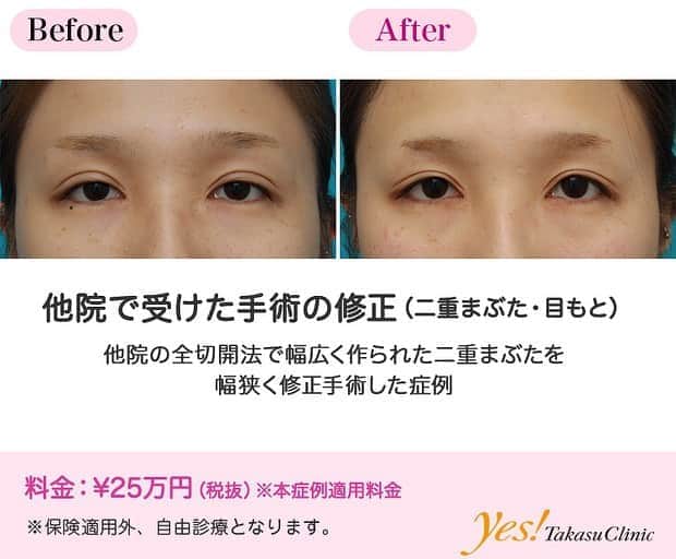高須クリニックのインスタグラム：「👨🏻‍⚕️高須幹弥医師からのコメント✨⠀ 20代女性の患者様で、6ヶ月以上前に他院で二重まぶた全切開法と目頭切開を受けていました。 二重の幅が思ったより広すぎたので、狭く修正してほしいという御要望でした。 診察させていただくと、幅がかなり広いため、目を開けた状態で二重のラインの下の皮膚がぷっくりと膨らんで覆い被さり、まつ毛の生え際が完全に隠れ、まぶたの開きが悪くなり、眠たそうな目になっていました。 前回の切開線を含めてまつ毛側の皮膚を切除して、二重のラインを作り直し、二重の幅を狭く修正することになりました。 他院で行われた全切開法は、皮膚を切除したかどうか不明でしたが、あまりまぶたの皮膚にゆとりはなく、皮膚を切除し過ぎると目を閉じることができなくなってしまうので、約5mm切除するのが限界でした。 内部処理をして皮膚を縫合する際、だぶついた皮膚が平らになって傷が綺麗になるように縫合しましたが、内側の目頭切開の窪んで目立つ傷は修正不能でした。 術後は目を開けた状態での二重の幅が半分程度になり、まぶたの開きも良くなりました。 まだ目を開けた状態で二重のラインの下の皮膚がぷっくり膨らんでまつ毛の生え際に被さっていますが、術前に比べればだいぶ改善しました。 これ以上皮膚を切除することができなかったため、二重の幅を狭くして自然に近づけるのはこれが限界でした。 ---------------------------------------------------- 🌈料金✨⠀ ●他院で受けた手術の修正（二重まぶた・目もと） （本症例適用料金） ¥250,000【東京、横浜、名古屋、大阪】 ※診察にてご確認ください ---------------------------------------------------- ⚠️リスク・副作用・合併症✨⠀ ●二重まぶた・全切開法 まぶたの強い腫れ（術後／個人差があります） 内出血（術後） 仕上がりの左右差（片目ずつ手術をする場合） 不自然な二重（無理に二重の幅を広げた場合） 仕上がりのわずかな左右差（完璧なシンメトリーは不可） 仕上がりが完璧に自分の理想の形にならないことがある 二重のラインの癒着がとれる可能性 手術後の血腫 --------------------------------------------------- 😊施術についての詳細✨⠀⠀ https://www.takasu.co.jp/photo/eye_modify04.html ---------------------------------------------------- 📞ご予約・お問い合わせ✨⠀ 0120-5587-10⠀ https://www.takasu.co.jp/cgi-bin/form/contact.cgi ※症例写真や施術に関するご質問なども上記までお願い致します。 ---------------------------------------------------- #他院で受けた手術の修正 #二重まぶた修正 #二重の幅を狭く修正#自然な二重 #二重修正  #皮膚 #美容 #美肌 #エイジングケア #美容整形 #美容外科 #美容クリニック #美容好き #美容皮膚科 #モニター #モニター募集 #高須クリニック #高須クリニック名古屋 #高須幹弥 #整形したい #プチ整形 #症例 #症例写真 #可愛くなりたい #可愛い #美人」