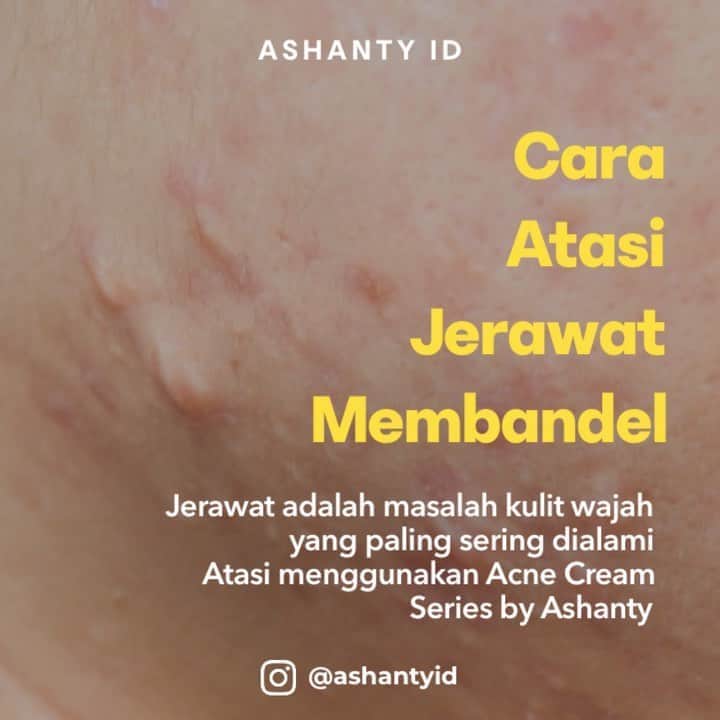 ASHANTY BEAUTY CREAM OFFICIALのインスタグラム：「Tidak perlu bingung dan khawatir jerawat membandel tak kunjung hilang! Solusi tepat untuk atasi masalah kulit wajah yang berjerawat hanya perlu rutin merawat wajah menggunakan Ashanty Beauty Cream Acne Series.  Membuat wajah terbebas dari jerawat membandel, pori - pori besar, flek hitam dan noda bekas jerawat. Selain mampu mengatasi masalah jerawat Acne Cream Series by Ashanty juga mampu mencerahkan dan melembabkan tanpa membuat wajah berminyak.   _____________________________ Informasi dan pemesanan  Ashanty Beauty Cream Chat Via WA : WA: 087778489900 WA: 081293823950 WA: 081287388885 WA: 085781140354 ⚡️ Fast Respons Click Link On Bio Instagram @ashantyid ❣️ ______________________________ #ashantybeautycream #creamashanty #skincareashanty #skincare #skincareartis #skincarelokal #creamwajah #creamperawatanwajah #obatjerawat #jerawat #kosmetik #krimwajah #creamwajah #whiteningcream #ashantyid #ashanty」