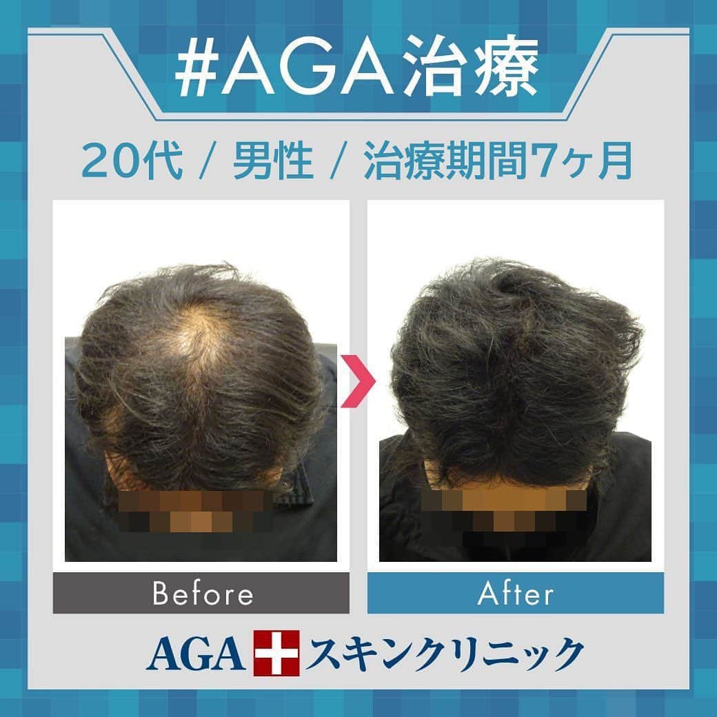 【公式】AGAスキンクリニックさんのインスタグラム写真 - (【公式】AGAスキンクリニックInstagram)「⭐️AGAスキンクリニック　Before⇒After⭐️ . 〇20代男性のケース 〇治療期間7か月 〇内容 ⇒オリジナル発毛薬 ⇒Dr'sメソ治療（AGA メソセラピー） . 頭頂部の薄毛が目立たななりました✨ ６～８ヶ月目では再度抜け毛が増える方もいらっしゃいます。 生え変わりの時期ですので基本的には心配いりません。 不安な点はクリニックまで遠慮なくご相談ください🐣 . AGAは早期治療が肝心です。 クリニックなど詳細は、@aga_clinic より公式HPをチェックしてみてください🥰 . . #AGAスキンクリニック#AGA#男性型脱毛症#AGA治療#薄毛#薄毛治療 #抜毛#発毛#育毛#治療#薬#ミノキシジル#AGAスキンクリニック症例 #フィナステリド#デュタステリド#髪質改善#頭皮ケア」9月29日 12時39分 - aga_clinic
