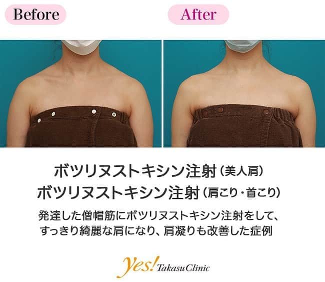 高須クリニックのインスタグラム：「👨🏻‍⚕️高須幹弥医師からのコメント✨⠀ 30代女性の患者様で、発達した僧帽筋（肩の筋肉）と肩凝りが悩みとのことでした。 診察させていただいたところ、僧帽筋が強く発達しており、肩が大きく盛り上がり、いかつい印象になっていました。 ボツリヌストキシンを僧帽筋の発達して盛り上がっている部分と、肩凝りの強い部分を中心に注射しました。 術後は僧帽筋の盛り上がっている部分が萎縮して、いかつかった肩がすっきりし、なだらかな女性らしい肩になりました。 また、肩凝りの症状も改善しました。 ボツリヌストキシン注射（肩こり・首こり）もボツリヌストキシン注射（美人肩）も、基本的には同じ薬を使用しているので、肩凝りといかつい肩の両方が悩みの方は、両方の症状が改善します。 ---------------------------------------------------- 🌈料金✨⠀ ●ボツリヌストキシン注射（美人肩） ¥150,000【全院】 ●ボツリヌストキシン注射（肩こり・首こり） ¥150,000【全院】 ---------------------------------------------------- ⚠️リスク・副作用・合併症✨⠀ ●ボツリヌストキシン注射（美人肩） 内出血（注射針が血管に当たってしまった場合） 妊活・妊娠・授乳中の方への施術不可 ●ボツリヌストキシン注射（肩こり・首こり） 内出血（注射針が血管に当たってしまった場合） 妊活・妊娠・授乳中の方への施術不可 --------------------------------------------------- 😊施術についての詳細✨⠀⠀ https://www.takasu.co.jp/photo/shoulder_botox05.html ---------------------------------------------------- 📞ご予約・お問い合わせ✨⠀ 0120-5587-10⠀ https://www.takasu.co.jp/cgi-bin/form/contact.cgi ※症例写真や施術に関するご質問なども上記までお願い致します。 ---------------------------------------------------- #ボツリヌストキシン注射 #美人肩 #肩凝り改善 #いかつい肩 #発達した僧帽筋 #すっきり綺麗な肩 #皮膚 #美容 #美肌 #エイジングケア #美容整形 #美容外科 #美容クリニック #美容好き #美容皮膚科 #モニター #モニター募集 #高須クリニック #高須クリニック名古屋 #高須幹弥 #整形したい #プチ整形 #症例 #症例写真 #可愛くなりたい #可愛い #美人」