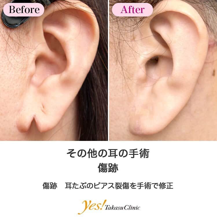 高須クリニックのインスタグラム：「👨🏻‍⚕️高須幹弥医師からのコメント✨⠀ 耳の悩みを抱えている人は、かなりの数にのぼります。その中でも多いのが、ピアスによる裂け。どうしてもこの部分に相手の視線が集中し、耳ばかり見られているのをとても気にされていました。 この方の場合は、裂け目部分を少し切開して縫合することで元の状態の耳元に近づけることができました。 ---------------------------------------------------- 🌈料金✨⠀ ●その他の耳の手術 片側 ¥150,000~500,000【東京、横浜、名古屋、大阪】 ●傷跡 顔面の傷跡を単純に縫合する場合の目安　1cm ¥50,000 / 顔面以外の傷跡を単純に縫合する場合の目安　1cm ¥25,000【東京、横浜、名古屋、大阪】 ※また、単純に直線で縫合するのではなく、複雑な手術になる場合は料金が割増になります。 ---------------------------------------------------- ⚠️リスク・副作用・合併症✨⠀ ●その他の耳の手術 手術後に処方する抗生剤や痛みどめによるアレルギー症状 仕上がりのわずかな左右差（完璧なシンメトリーは不可） ●傷跡 手術後に処方する抗生剤や痛みどめによるアレルギー症状 傷跡が肥厚性瘢痕やケロイドになる可能性 手術後の血腫 --------------------------------------------------- 😊施術についての詳細✨⠀⠀ https://www.takasu.co.jp/photo/mimiother04.html ---------------------------------------------------- 📞ご予約・お問い合わせ✨⠀ 0120-5587-10⠀ https://www.takasu.co.jp/cgi-bin/form/contact.cgi ※症例写真や施術に関するご質問なども上記までお願い致します。 ---------------------------------------------------- #傷跡 #その他の耳の手術 #耳の手術 #ピアス裂傷 #ピアスによる裂け  #皮膚 #美容 #美肌 #エイジングケア #美容整形 #美容外科 #美容クリニック #美容好き #美容皮膚科 #モニター #モニター募集 #高須クリニック #高須クリニック名古屋 #高須幹弥 #整形したい #プチ整形 #症例 #症例写真 #可愛くなりたい #可愛い #美人」
