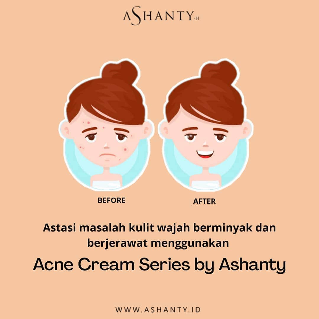 ASHANTY BEAUTY CREAM OFFICIALのインスタグラム：「Kamu tidak perlu khawatir jika kulit wajah mulai kusam,  berminyak dan berjerawat. Mulailah merawat wajah menggunakan rangkaian acne series by @ashantyid ✨  Merawat dan menutrisi kulit wajah secara maksimal hingga lapisan terdalam kulit, membuat wajah lebih sehat, cerah berseri, lembut, lembab, bebas kusam dan jerawat membandel 🌸」