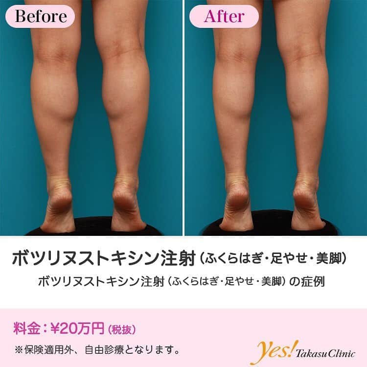 高須クリニックのインスタグラム：「👨🏻‍⚕️高須幹弥医師からのコメント✨⠀ 30代の女性患者様です。 学生時代にテニスをしていたので、ふくらはぎの筋肉が発達して太くなっていました。 下半身の筋肉というのは、一度運動して太くしてしまうと、運動をやめてもなかなか落ちないものですが、ボツリヌストキシンを注射すると細くすることができます。 ボツリヌストキシン注射の効果は、通常6ヶ月くらいなのですが、高須クリニックでは質が良く高濃度のボツリヌストキシン注射を使用しているので、私の経験では、6ヶ月以上経って薬の効果がなくなっても、3割程度の効果は半永久的に続きます。 そのため、繰り返し注射をすることによって、さらに細くしていくことができます。 ふくらはぎを細くする治療は、ボツリヌストキシン注射以外にも、脂肪吸引やイタリアン・メソシェイプ（イタリアンメソセラピー）・脂肪溶解注射などがありますが、ボツリヌストキシン注射が最も効果がでる方が多いです。 ---------------------------------------------------- 🌈料金✨⠀ ●ボツリヌストキシン注射（ふくらはぎ・足やせ・美脚） ¥200,000【全院】 ---------------------------------------------------- ⚠️リスク・副作用・合併症✨⠀ ●ボツリヌストキシン注射（ふくらはぎ・足やせ・美脚） 内出血（注射針が血管に当たってしまった場合） 妊活・妊娠・授乳中の方への施術不可 わずかに筋力が弱くなる --------------------------------------------------- 😊施術についての詳細✨⠀⠀ https://www.takasu.co.jp/photo/leg_02.html ---------------------------------------------------- 📞ご予約・お問い合わせ✨⠀ 0120-5587-10⠀ https://www.takasu.co.jp/cgi-bin/form/contact.cgi ※症例写真や施術に関するご質問なども上記までお願い致します。 ---------------------------------------------------- #ボツリヌストキシン注射 #ふくらはぎ #足やせ #美脚 #ふくらはぎを細くしたい  #皮膚 #美容 #美肌 #エイジングケア #美容整形 #美容外科 #美容クリニック #美容好き #美容皮膚科 #モニター #モニター募集 #高須クリニック #高須クリニック名古屋 #高須幹弥 #整形したい #プチ整形 #症例 #症例写真 #可愛くなりたい #可愛い #美人」