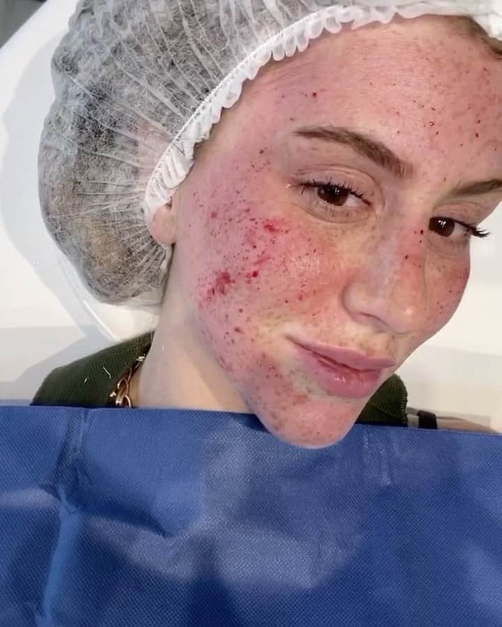 のインスタグラム：「Pra quem quis saber como fica 48 HORAS APÓS O microagulhamento❣️」