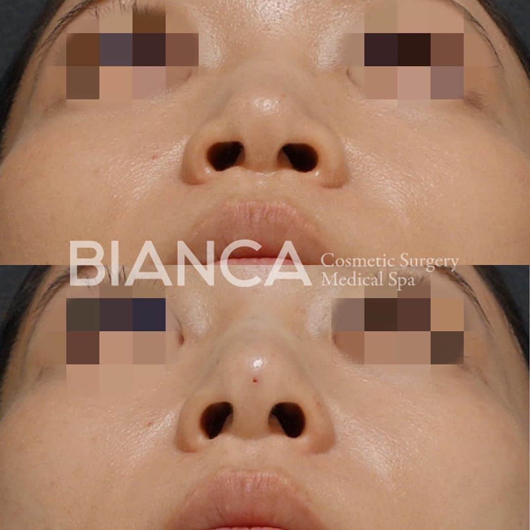 辻沢由有（BIANCA CLNIC 表参道院 院長）さんのインスタグラム写真 - (辻沢由有（BIANCA CLNIC 表参道院 院長）Instagram)「【鼻先をその日から高く✨】﻿ ﻿ お顔の真ん中にある【お鼻】﻿ は、洗練させるためにとても大切なパーツ。﻿ ﻿ 大人気の鼻ヒアルロン酸。﻿ 特殊な技術で、鼻先への注入も可能です🥰﻿ ﻿ 上 注入前﻿ 下 注入直後 ﻿ ﻿ この圧倒的な治療効果が #BIANCAクオリティ 🙌﻿ ﻿ とっても人気なこの治療、モニター様も募集しております😊✨﻿ お気軽にお問い合わせください。﻿ ﻿ 🌸鼻先 鼻筋ヒアルロン酸﻿ 💉Juvederm VOLUX XC 1ml 98,000円﻿ 別途施術料20000円﻿ ⏳治療時間: 10分﻿ 🗓持続期間: 1〜2年﻿ 😷腫れ・内出血: 数日程度﻿ ⚠️リスク: 感染・血流障害・凹凸など﻿ ﻿ ﻿ ⚠️ご予約の際は﻿ 『Dr Yuu（辻沢）のインスタ見た』の一言をお願いします👩‍⚕️✨﻿ ﻿ 📍BIANCA CLINIC﻿ ✔︎表参道院﻿ 03-6433-5994﻿ 東京都港区南青山5-11-10  南青山511ビル 2F﻿ ✔︎銀座院﻿ 03-6263-2690 ﻿ 東京都中央区銀座1-5-6 銀座レンガ通り福神ビル 4F﻿ 診療時間 10:00〜19:00﻿ 年中無休（年末年始を除く） ﻿ ﻿ ﻿ #ワークアウト#プチ整形#顎ヒアルロン酸#美容好きな人と繋がりたい#ダイエット#綺麗になりたい #経営者 #美容外科 #cosmeticsurgery #plasticsurgery #biancaclinic #ビアンカクリニック #プレ花嫁さんと繋がりたい #followｍe #フォローミー #小顔治療 #女医 #モニター募集 #モニター募集中#若返り #キャバ嬢 #リフトアップ #美魔女 #小顔整形  #鼻ヒアルロン酸 #額ヒアルロン酸 #鼻整形 #ホスト  #dryuuヒアル」10月8日 15時32分 - i_am_yuu__