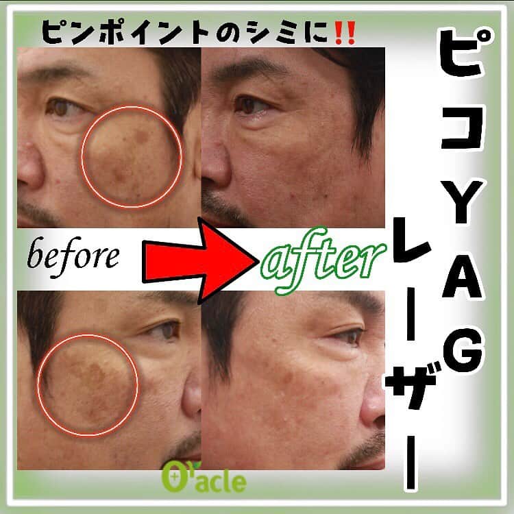 オラクル美容皮膚科東京新宿院さんのインスタグラム写真 - (オラクル美容皮膚科東京新宿院Instagram)「﻿ 【シミ症例】﻿ 左：施術前﻿ 右側：ルメッカで5回・ピコスポットで1回治療💁‍♂️﻿ ﻿ 左側の目立つシミはかなり綺麗になりました！﻿ まだ右側のシミが気になるということで半年ぶりに2回目のピコスポットを受けられました😊﻿ ﻿ 10月はピコスポットが含まれた『1dayシミ管理』がおススメ⇩⇩⇩﻿ ①ピコスポット(ピコYAG)[1cm×1cm]﻿ ﻿ ②ピコトーニング﻿ ﻿ ③ルメッカ　両頬﻿ ﻿ ④SRSマスク1枚﻿ ﻿ ⑤麻酔　⑥再生テープ1枚　⑦ハイドロキノン﻿ ﻿ ﻿ 💰料金💰﻿ 1dayシミ管理　10月➡68,000円❣　通常76,000円﻿ ﻿ ピコYAG　1cm×1cm　10,000円﻿ ※税抜き﻿ ﻿ ﻿ 目立つシミにはピコYAGでしっかり改善が🙆﻿ シミ治療は紫外線が減ってきた今この時期から始めるのがタイミングです⏰﻿ お問合せが多くなっていますので、ご予約はお早めに！！﻿ ﻿ ▪️▫️▪️▫️▪️▫️▪️▫️▪️▫️﻿ ﻿ 🇯🇵オラクル美容皮膚科🇰🇷﻿ 📍東京新宿院﻿ 新宿3丁目19-4 MLJ新宿8階﻿ ﻿ 📍名古屋院﻿ 名古屋市中区錦3丁目24-4﻿ サンシャイン栄5階﻿ ﻿ 【専門】﻿ ニキビ（跡）／毛穴／シミ／しわ／たるみ／痩身／アンチエイジング／美白美肌治療全般／ブライダル相談／メンズ美容﻿ ﻿ 🗝完全予約制﻿ 👠土日祝日も診療﻿ ﻿ 【予約方法】﻿ ☎0120-905-696﻿ ⏰9:00～21:00［年中無休］﻿ ﻿ LINE、メール24時間📧﻿ LINE🆔 @oracle.jp ﻿ 📩HPメールフォームよりお願いいたします﻿ ﻿ ﻿ ▪️▫️▪️▫️▪️▫️▪️▫️▪️▫️﻿ ﻿ #オラクル美容皮膚科 #オラクル ﻿ #oracle #韓国美容 #美容皮膚科 ﻿ #皮膚科 #美容 #小顔矯正 #コラーゲン #美容オタク #美容マニア  #ヒアルロン酸 #弾力 #ハリ #美白 #トーンアップ #肌質改善 #일본피부과 #오라클피부과 #皮膚科 #シワ #美肌 #美肌ケア #肌管理 #韓国美容皮膚科 #シミ #ピコレーザー #ピコyagレーザー #シミ取り #シミ取りレーザー」10月8日 16時26分 - oraclejp