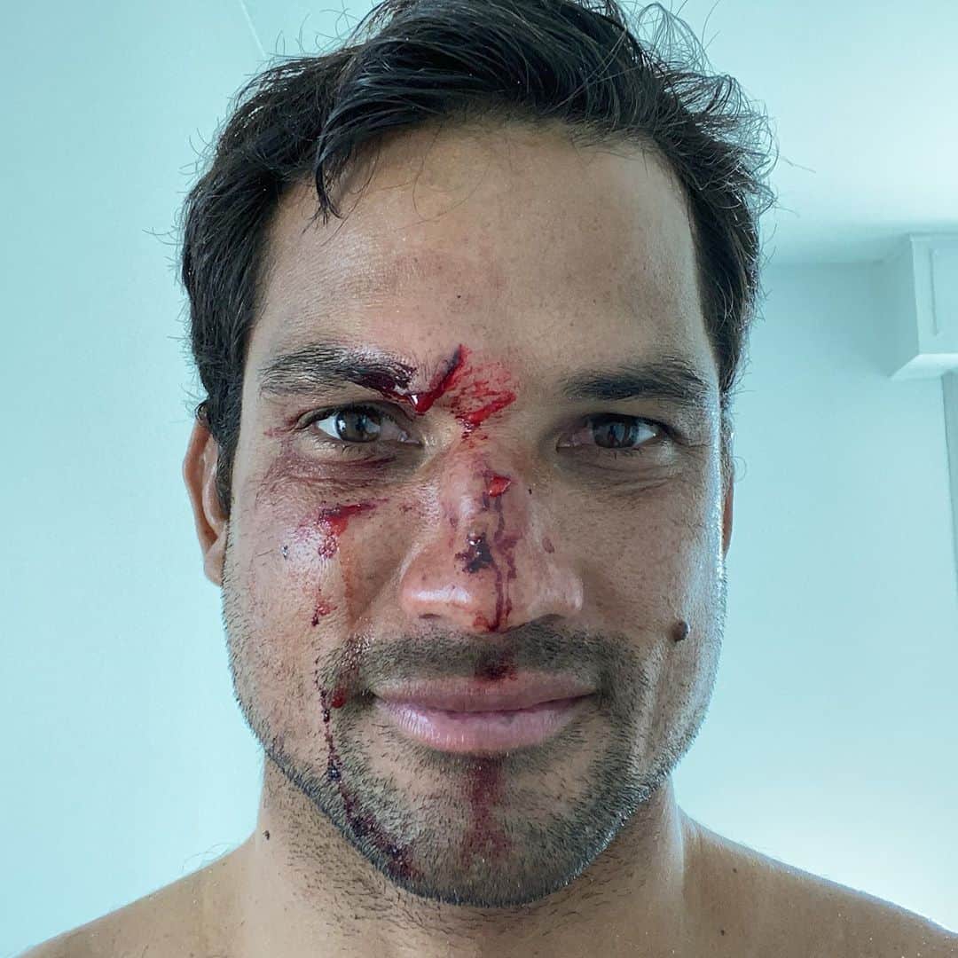 ミシェル・ボレーズのインスタグラム：「@firewiresurfboards  1 michel 0  😅😅😅😅 The waves are pumping here in france 🇫🇷, but I will be watching this afternoon. 😤😤😤 Luckily my eye is fine ! No surf for a few days ! Let the storm begin 🤕 #injurylover」