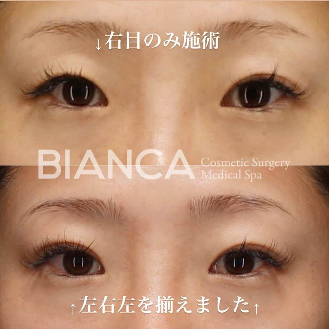 辻沢由有（BIANCA CLNIC 表参道院 院長）さんのインスタグラム写真 - (辻沢由有（BIANCA CLNIC 表参道院 院長）Instagram)「【左右差を改善✨】 以前より気にされていた二重の左右差を片目のみの埋没法により揃えました😌 生まれつきの差を完全に揃えることは難しい場合もありますが、きになる方は一度カウンセリングにお越しいただければ幸いです👩‍⚕️✨  💉埋没4点留め 💴148,000円（両眼）、103,600円（片眼） 😷腫れ 内出血:数日〜1週間程度﻿  ⚠️ご予約の際は﻿ 『Dr Yuu（辻沢）のインスタ見た』の一言をお願いします👩‍⚕️✨﻿ ﻿ 📍BIANCA CLINIC﻿ ✔︎表参道院﻿ 03-6433-5994﻿ 東京都港区南青山5-11-10  南青山511ビル 2F﻿ ✔︎銀座院﻿ 03-6263-2690 ﻿ 東京都中央区銀座1-5-6 銀座レンガ通り福神ビル 4F﻿ 診療時間 10:00〜19:00﻿ 年中無休（年末年始を除く） ﻿ ﻿ #美容好き#プチ整形#美魔女#美容好きな人と繋がりたい#美容垢#綺麗になりたい #美容皮膚科 #美容外科 #cosmeticsurgery #plasticsurgery #biancaclinic #ビアンカクリニック  #followｍe #フォローミー #銀座 #女医 #モニター募集 #モニター募集中#若返り #イメチェン #二重切開 #二重埋没 #二重整形  #二重になりたい #ヒアルロン酸 #女医 #アンチエイジング #埋没法 #beauty #二重埋没法 #dryuu目」10月9日 17時07分 - i_am_yuu__