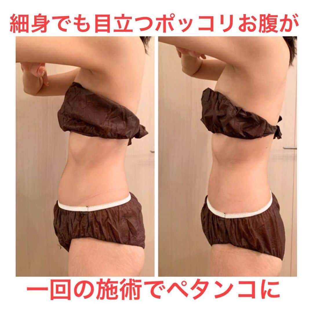 埼玉エステ＊インディバ＊戸田公園＊戸田市＊痩身＊冷え改善のインスタグラム：「服を着ていると「細いね！スタイルがいいね！」と周りからは言われるけれど﻿ 自分では気になるポッコリ下腹部。﻿ ﻿ 他の部分にサイズを合わせて洋服を買っても﻿ どうもお腹だけ目立ってしまう。﻿ ﻿ 食事を減らしてみても腹筋をしてみても、どうも下腹部のポッコリだけは減らない。﻿ ﻿ そんなお悩みはお任せください☺️﻿ ﻿ 見た目は細いと言われるのに、実はずっと悩んでいたポッコリ下腹部が﻿ 施術後にはペタンコになっていてとても驚かれていました。﻿ ﻿ スッキリとサイズダウンして、自信を持って秋のオシャレを楽しんでくださいね😌﻿ ＿＿＿＿＿＿＿＿＿＿＿＿＿＿＿＿＿＿﻿ ﻿ 埼京線 戸田公園 徒歩8分﻿ ダイエット専門サロン【ベルーヌ】﻿ ﻿ ご予約・お問い合わせは﻿ @misako.bell-nu ﻿ トップページリンクより﻿ ﻿ 定休日　日・祝﻿ 営業時間　10:00〜17:00﻿ ＿＿＿＿＿＿＿＿＿＿＿＿＿＿＿＿＿＿﻿ ﻿ ﻿ #戸田市 #戸田公園 #戸田公園エステ #蕨　#武蔵浦和　#赤羽　#朝霞　#川口﻿ #インディバ #インディバサロン #痩身が得意﻿ #冷え改善　#体質改善　#体温アップ　#深部体温　#温活　#痩せたい　#痩せにくい　#痩せなくなった　#太りやすい　#サイズダウン　#お腹痩せ　#お腹引っ込めたい」