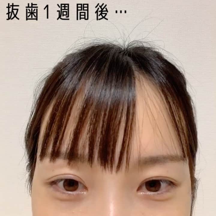 さくまみおのインスタグラム：「どうも、ぷんぷく丸です。 先月、厄介な生え方をしていた親知らずを同時に抜歯してもらうという我が人生初の全身麻酔による手術なるものをしてもらいました😤🦷✨  手術台に上がったらド、ドラマだ…ってすっごくドキドキしたけど看護師のお姉さん達が優しくてずっと手握っててくれたので安心して3秒で眠りにつきました😪zzz  前日寝不足だったからか夢も見ず爆睡🤤𓂃 𓈒𓏸 手術中に目覚めちゃった方の話とかも聞いてたから怯えていたけどよく寝た〜‪と目覚めたら入院する🛏の上にいました😳!!!  高熱が出たり吐き気に襲われる場合もあるって聞いてたけど、ドクターの腕か、日頃の健康生活のおかげか、37度くらいまでしか上がらず痛みも耐えれるくらいのジンジンだったのでずっとクレヨンしんちゃんの映画観てました。 笑うと痛いから大変でした(じゃあ観るなよ)  帰宅後は地味〜な痛さで数時間置きに目覚めるのがストレスだったかなぁ(´・ω・｀) 5日もすれば爆睡してたけど🤤💤  まぁなんといっても1番の衝撃は噂通りの腫れっぷりwww 術後2〜3日がピークで公開するか迷ったけど…自分でも見慣れてきたので公開します。笑 姉ちゃんには思ったほど腫れてないからつまらんと言われましたが元々コケてた人間なので個人的には衝撃の丸さ…いや、四角さ？笑 口腔外科の先生にはバンドはあんまり強くしなくていいと言われたけど、バンドは重要って聞いてたから早く腫れ引かせたくて強めに巻いてたらなんか目とか鼻とか親知らず関係ないだろって所まで腫れてきた気が😂みんな…バンドは強すぎ注意だ！←  しかし流動食生活は痩せる…さすがに30kg台に入ると危機感を覚えるので飽きないように色んなの探してモリモリ食べてますᕙ( ˙-˙ )ᕗ🍛🍛🍛!!!!! 今はこんなに色々あるんですね😳幸せな時代だぁ〜🙇🏻‍♀️✨これから親知らず抜く方オススメです！普通に美味しい！！！ 一番美味しかったのは友達がサプライズで送ってくれたスープストックトウキョウのスープセット🥰愛が沁みたぜありがとう🥺✨  そんなこんなでまだ抜糸も出来てないので腫れてますけど、以上ぷんぷく丸の途中経過報告でした。  #親知らずレポ#ぷんぷく丸日記」