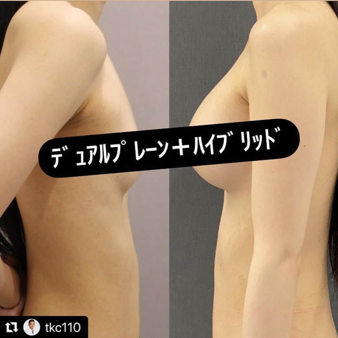 東京美容外科公式のインスタグラム：「#Repost @tkc110 with @make_repost ・・・ デュアルプレーン豊胸とハイブリッド豊胸、どっちが自然な形？ と、聞かれることがありますが、デュアルプレーン法で行った場合、大胸筋でカバーできるのはバストトップ〜デコルテラインです。シリコンの形が浮き出やすい部分なので、そこをカバーするなら圧倒的にデュアルプレーン豊胸でしょうか？ ハイブリッド豊胸で脂肪注入を併用した場合、バスト全体に入れられるので、シリコンの触れやすさを緩和することができます。また、デコルテや谷間もカバーできるので、ある程度脂肪が取れる人なら適応範囲は広い治療法です。 とてもバストが小さくて、皮下脂肪も全然無い痩せ型の人は厳しいですが。。 まあ、写真のように両方やる場合もあります。 因みに、それらの特殊な豊胸を推してるわけではありません。必要ない人には全く勧めません。 ただ、痩せ型で元のバストが無いのに、無理矢理乳腺下にシリコン入れて、形が浮き出過ぎてる人の相談も受けるので、シリコン豊胸にも色々ありますよってだけなので、ご参考にしてください。 #小野准平 #豊胸 #シリコン豊胸 #脂肪注入豊胸 #デュアルプレーン豊胸 #ハイブリッド豊胸」