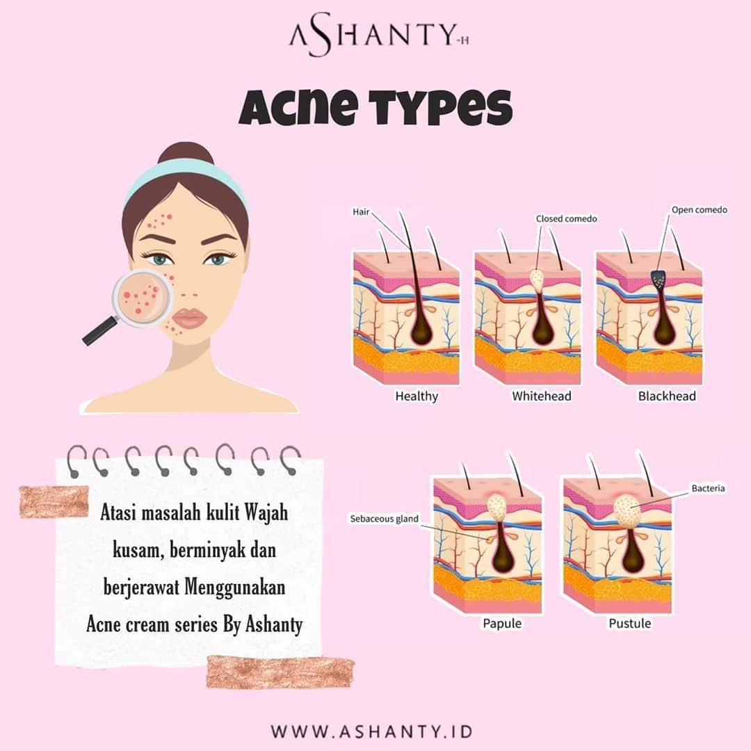 ASHANTY BEAUTY CREAM OFFICIALのインスタグラム：「Ketahui jenis jerawat diwajah dan cara mengatasinya! Acne Cream Series by Ashanty adalah pilihan tepat untuk merawat dan menutrisi kulit wajah yang kusam, berminyak, komedo, pori - pori besar dan berjerawat ✨🌸  _____________________________ Informasi dan pemesanan  Ashanty Beauty Cream Chat Via WA : WA: 081287388885 WA: 085781140354 WA: 087778489900 WA: 081293823950 ⚡️ Fast Respons Click Link On Bio Instagram @ashantyid ❣️ ______________________________ #ashantybeautycream #creamashanty #skincareashanty #skincare #skincareartis #skincarelokal #creamwajah #creamperawatanwajah #obatjerawat #jerawat #kosmetik #krimwajah #creamwajah #whiteningcream #ashantyid #ashanty」