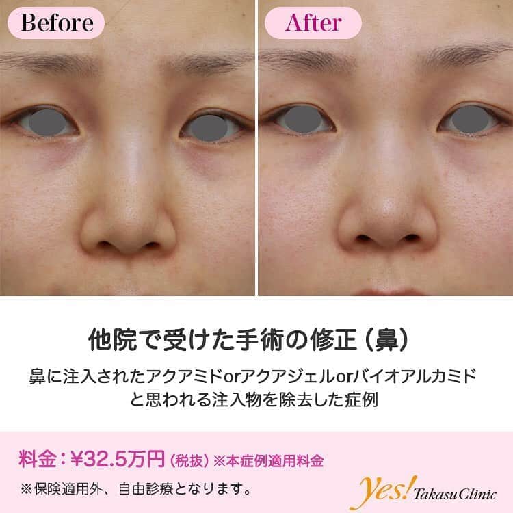 高須クリニックのインスタグラム：「👨🏻‍⚕️高須幹弥医師からのコメント✨⠀ 20代女性の患者様で、他院で鼻を高くするために、注射をしたとのことでした。 眉間から鼻根部にかけて大量に注入されており、不自然に横に広がっていました。 何を注入されたのかわからないため、ヒアルロン酸の可能性を考え、ヒアルロニダーゼを注射してみましたが、全く変化がありませんでした。 ぶよぶよしたジェル状の感触であり、アクアミド、アクアジェル、バイオアルカミドなどの非吸収性の注入物の可能性が高いため、局所麻酔下に鼻の穴の中から除去手術をしました。 注入物の8~9割くらいを除去することができ、術後は自然な鼻になりました。 ---------------------------------------------------- 🌈料金✨⠀ ●他院で受けた手術の修正（鼻） （本症例適用料金） ¥325,000【東京、横浜、名古屋、大阪】 ※診察にてご確認ください ---------------------------------------------------- ⚠️リスク・副作用・合併症✨⠀ ●他院で受けた手術の修正（鼻） 手術後に処方する抗生剤や痛みどめによるアレルギー症状 ●ヒアルロン酸分解・溶解（ヒアルロニダーゼ注射） 内出血（注射針が血管に当たってしまった場合） アレルギーが生じる可能性 --------------------------------------------------- 😊施術についての詳細✨⠀⠀ https://www.takasu.co.jp/photo/nose_hanaaquamid03.html ---------------------------------------------------- 📞ご予約・お問い合わせ✨⠀ 0120-5587-10⠀ https://www.takasu.co.jp/cgi-bin/form/contact.cgi ※症例写真や施術に関するご質問なども上記までお願い致します。 ---------------------------------------------------- #他院で受けた手術の修正 #鼻修正 #自然な鼻 #注入物除去 #アクアミド #アクアジェル #バイオアルカミド  #皮膚 #美容 #美肌 #エイジングケア #美容整形 #美容外科 #美容クリニック #美容好き #美容皮膚科 #モニター #モニター募集 #高須クリニック #高須クリニック名古屋 #高須幹弥 #整形したい #プチ整形 #症例 #症例写真 #可愛くなりたい #可愛い #美人」