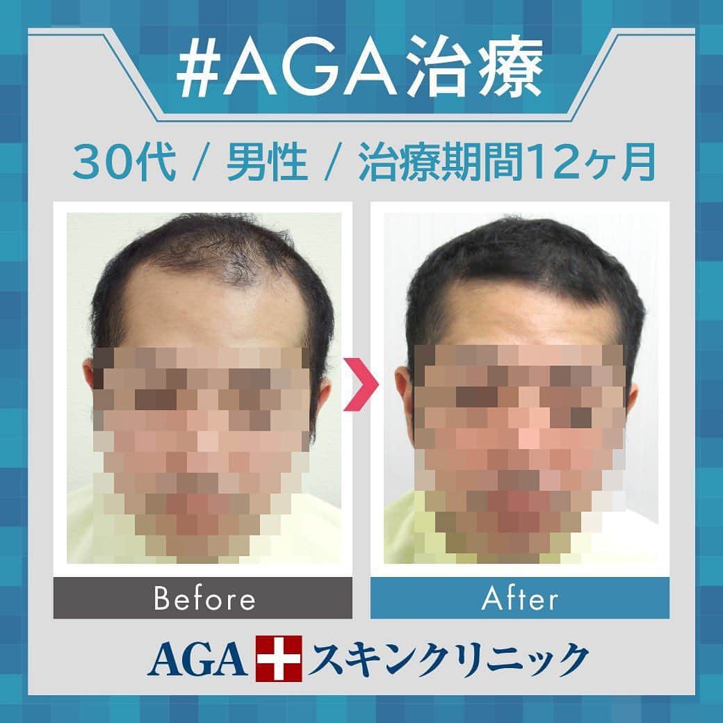 【公式】AGAスキンクリニックさんのインスタグラム写真 - (【公式】AGAスキンクリニックInstagram)「⭐️AGAスキンクリニック　Before⇒After⭐️ . 〇30代男性のケース 〇治療期間12か月 〇内容 ⇒オリジナル発毛薬 ⇒Dr'sメソ治療（AGA メソセラピー） . 全体的にボリュームUP✨ トップの薄毛が改善され生え際の密度も復活してきました！ . AGAは早期治療が肝心です。 クリニックなど詳細は、@aga_clinic より公式HPをチェックしてみてください🥰 . . #AGAスキンクリニック#AGA#男性型脱毛症#AGA治療#薄毛#薄毛治療#抜毛#発毛#育毛#治療#薬#ミノキシジル#AGAスキンクリニック症例#フィナステリド#デュタステリド#髪質改善#頭皮ケア」10月14日 11時57分 - aga_clinic