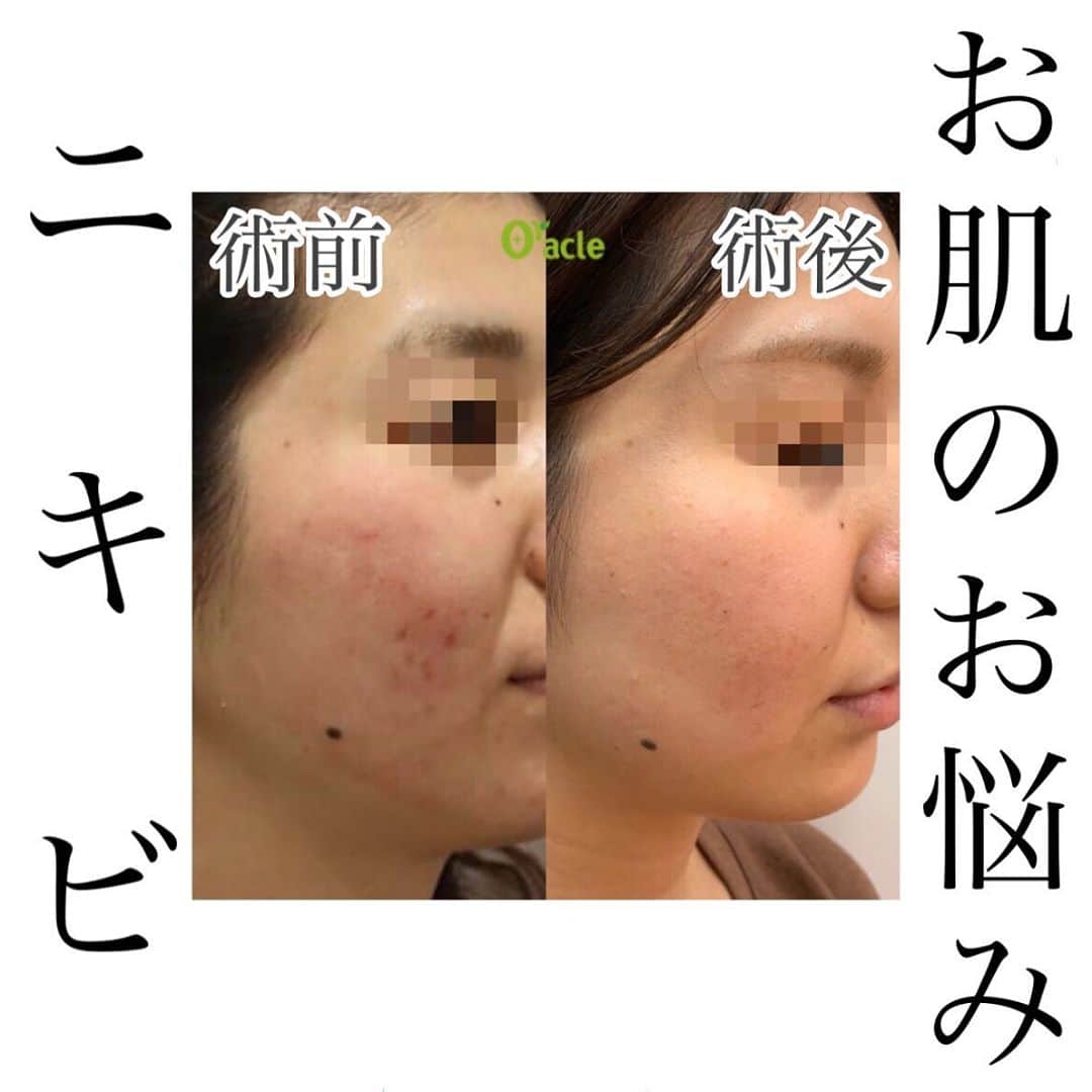 オラクル美容皮膚科東京新宿院さんのインスタグラム写真 - (オラクル美容皮膚科東京新宿院Instagram)「﻿ ニキビ症例のご紹介💁‍♀️﻿ ﻿ この治療を受けられました﻿ ⬇︎⬇︎⬇︎﻿ BHAピーリング　2回﻿ マスクミルクピーリング﻿ フラクセル﻿ オラクルパックなどで定期的に保湿﻿ ﻿ ﻿ 今回はこの中でも繰り返すニキビに有効な﻿ BHAピーリングのご紹介です✨﻿ ﻿ サリチル酸を使用したピーリングで﻿ ニキビができづらいお肌に改善します。﻿ 繰り返しできてしまうニキビにおすすめ！﻿ ﻿ 定期的に行うことで治療効果が高まります😃﻿ ﻿ 💰料金💰﻿ 1回　¥10,000(税抜)﻿ ﻿ リスクなど﻿ 2~3日で角質が薄くむけ始めますが、色素沈着の原因になりますので無理にはがさないようにしてください。﻿ スクラブは1週間はさけ、保湿をしっかり行うようにしてください。﻿ ﻿ ▪️▫️▪️▫️▪️▫️▪️▫️▪️▫️﻿ ﻿ 🇯🇵オラクル美容皮膚科🇰🇷﻿ 📍東京新宿院﻿ 新宿3丁目19-4 MLJ新宿8階﻿ ﻿ 📍名古屋院﻿ 名古屋市中区錦3丁目24-4﻿ サンシャイン栄5階﻿ ﻿ 【専門】﻿ ニキビ（跡）／毛穴／シミ／しわ／たるみ／痩身／アンチエイジング／美白美肌治療全般／ブライダル相談／メンズ美容﻿ ﻿ 🗝完全予約制﻿ 👠土日祝日も診療﻿ ﻿ 【予約方法】﻿ ☎0120-905-696﻿ ⏰9:00～21:00［年中無休］﻿ ﻿ LINE、メール24時間📧﻿ LINE🆔 @oracle.jp ﻿ 📩HPメールフォームよりお願いいたします﻿ ﻿ ﻿ ▪️▫️▪️▫️▪️▫️▪️▫️▪️▫️﻿ ﻿ #オラクル美容皮膚科 #オラクル ﻿ #oracle #韓国美容 #美容皮膚科 ﻿ #皮膚科 #美容 #小顔矯正 #コラーゲン #美容オタク #美容マニア  #ヒアルロン酸 #弾力 #ハリ #美白 #保湿 #ゆらぎ肌 #일본피부과 #오라클피부과 #ニキビ改善 #ピーリング #美肌 #美肌ケア #肌管理 #韓国美容皮膚科 #ニキビ跡ケア #ニキビ跡 #ニキビケア #ニキビ #美容」10月14日 17時41分 - oraclejp