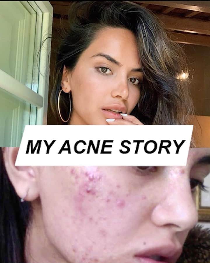 Diipa Büller-Khoslaのインスタグラム：「A new #DiipaStories about one of my most requested skin questions: How I cleared my 10 years of acne?  Im am obsessed with skincare as you know and am honestly so proud of having the healthiest skin and body of my life. 🙌🏽👏🏽 #RealOverPerfect」