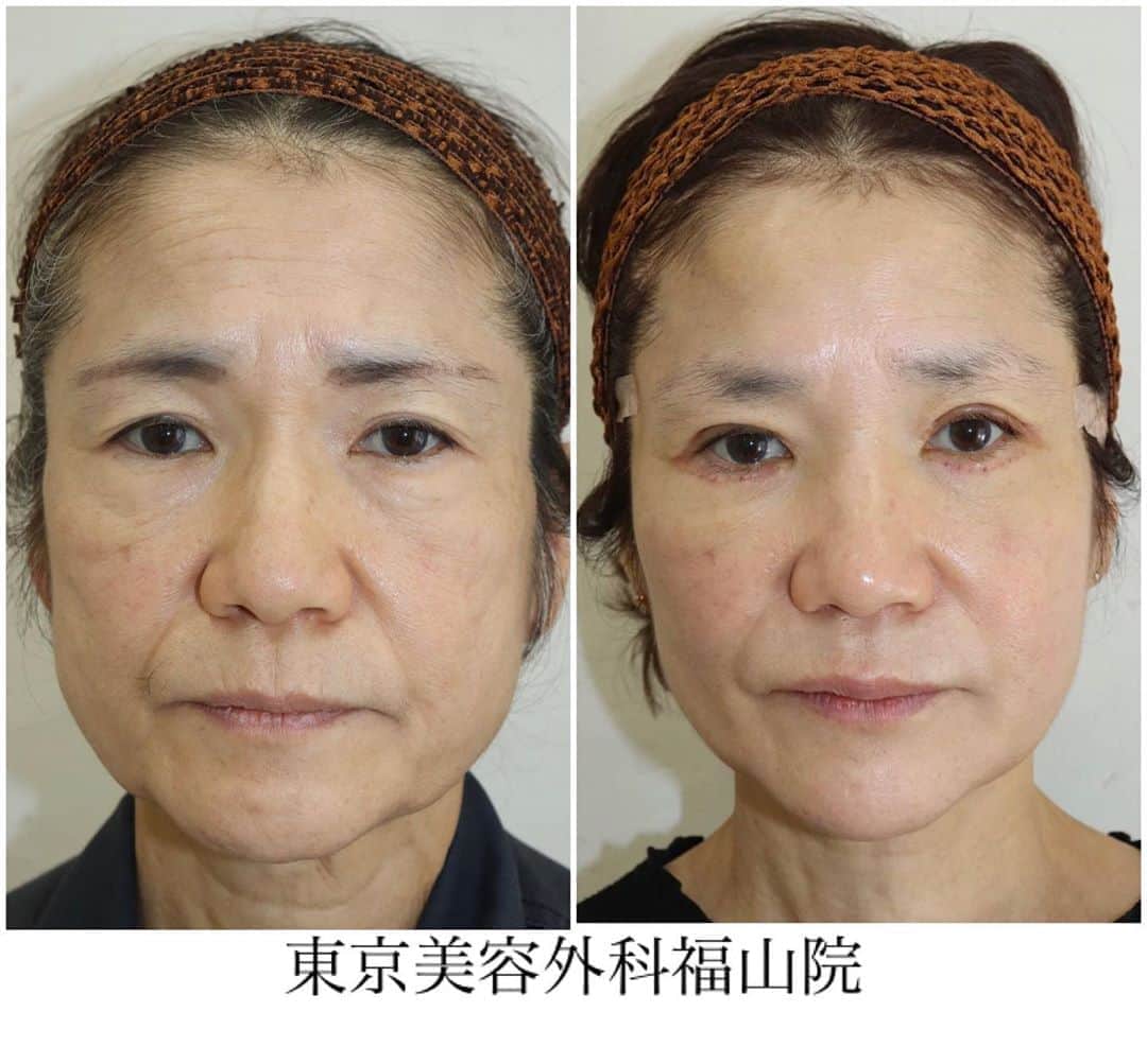 東京美容外科公式さんのインスタグラム写真 - (東京美容外科公式Instagram)「こんにちは✨ 🌹東京美容外科福山院です🌹 . 劇的変化‼️ 目元の脂肪を除去、 フェイスリフトで タルミ改善✨ ヒアルロン酸、ボトックスで若返り🙆‍♀️ ここまで変わります‼️ . フェイスリフトとは🤔？  フェイスリフトは、皮膚のみを引き上げるのではなく SMAS筋膜(顔のラインを支えている筋膜、靭帯)を 同時に引き上げて、たるみを解消🧚‍♀️  東京美容外科では、皮膚とSMAS筋膜を 同時に引き上げる方法に加え、 広範囲にplication[重ね縫い]を加える方法を取り、 靭帯（リガメント）を支持組織として 再利用することによって、 若返り効果や効果の持続性を高めています👨🏻‍⚕️  . 写真上:術前 写真下:術1週間後  . 担当医👨🏻‍⚕️ @dr.tomita___official    フェイスリフト、 ブローリフト、 目の下たるみ脂肪取り ヒアルロン酸、ボトックス  リスク⚠️腫れ、内出血、感染、左右差 . カウンセリングは無料です🆓 お気軽にお越し下さいませ❣️ . 【東京美容外科】 ====□お問い合わせはこちら□===== ▼フリーダイヤル ☎0120-658-958 （コールセンター受付時間：9：00～21：00） . ▼LINE予約 @ tkc110 ============== #東京美容外科#福山#オルチャンリフト#ニキビ肌#汗管腫#綺麗#beautiful#二重#プチ#kawaii#コンプレックス #アイプチ#卒業#キャンペーン#モデル#モニター#目力#美容#美意識#女子力#可愛い#美白ケア#唇#プルプル#ラシャスリップス #美容クリニック」10月16日 17時01分 - tokyobiyougeka_jimukyoku