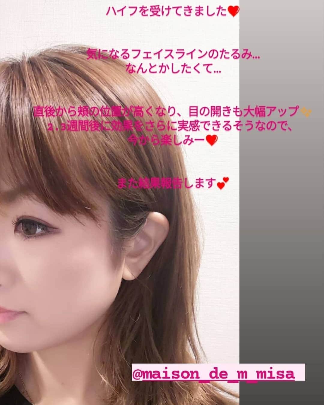 中島彩のインスタグラム：「インテリアがとっても可愛いサロンへ💕 気になるフェイスラインのたるみ... 二重顎にほうれい線...😭 ずっと悩んでいたので、ハイフを受けてきました❤️ 直後から変化を感じることはできたけど、効果のピークは２週間から３週間後とのこと😍 変化が楽しみ ..💕  ビフォアフ写真を見て...❤️ @maison_de_m_misa でお世話になりました❤️  #ハイフ　#アンチエイジング　#エイジングケア #ビフォアフ　#ハイフエステ」