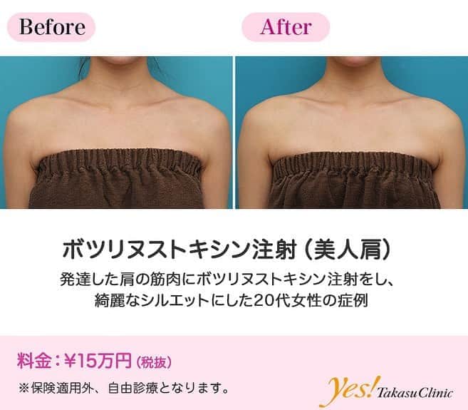 高須クリニックのインスタグラム：「👨🏻‍⚕️高須幹弥医師からのコメント✨⠀ 20代女性の患者様で、肩のラインをすっきりさせたいというご要望でした。 診察させていただいたところ、僧帽筋の上部がやや発達気味で、盛り上がっていました。 そのことにより、女性の肩のラインとしては、ややイカつい、ゴツいといった印象を与える感じになっていました。 そのため、美人肩ボツリヌストキシン注射を行い、僧帽筋の上部を萎縮させ、すっきりさせることになりました。 治療は、注射部位の皮膚に麻酔クリームを塗ったあと、細い注射針で、発達して厚みのある部分の僧帽筋に細かくボツリヌストキシンを注入しました。 注射後1ヶ月半の時点では、発達していた筋肉は程よく廃用性萎縮を起こして小さくなり、綺麗な肩のシルエットラインになりました。 ---------------------------------------------------- 🌈料金✨⠀ ●ボツリヌストキシン注射（美人肩） ¥150,000【全院】 ---------------------------------------------------- ⚠️リスク・副作用・合併症✨⠀ ●ボツリヌストキシン注射（美人肩） 内出血（注射針が血管に当たってしまった場合） 妊活・妊娠・授乳中の方への施術不可 --------------------------------------------------- 😊施術についての詳細✨⠀⠀ https://www.takasu.co.jp/photo/beautiful_shoulder_botox006.html ---------------------------------------------------- 📞ご予約・お問い合わせ✨⠀ 0120-5587-10⠀ https://www.takasu.co.jp/cgi-bin/form/contact.cgi ※症例写真や施術に関するご質問なども上記までお願い致します。 ---------------------------------------------------- #ボツリヌストキシン注射 #美人肩 #肩のラインをすっきりさせたい #綺麗な肩  #皮膚 #美容 #美肌 #エイジングケア #美容整形 #美容外科 #美容クリニック #美容好き #美容皮膚科 #モニター #モニター募集 #高須クリニック #高須クリニック名古屋 #高須幹弥 #整形したい #プチ整形 #症例 #症例写真 #可愛くなりたい #可愛い #美人」