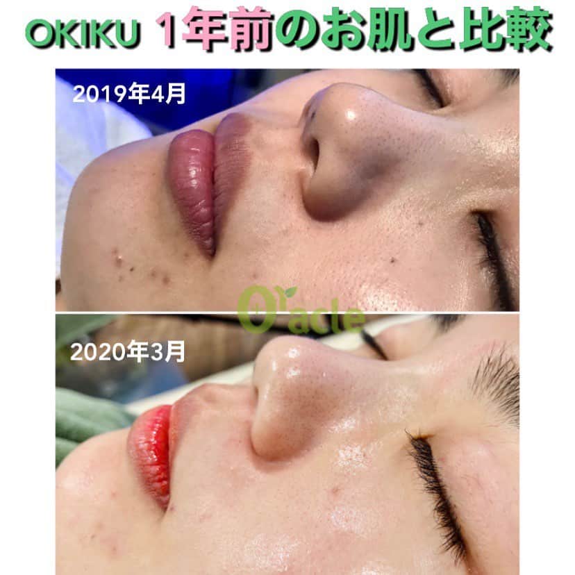 オラクル美容皮膚科東京新宿院さんのインスタグラム写真 - (オラクル美容皮膚科東京新宿院Instagram)「《1年の治療の結果　お肌の比較》﻿ 先日OKIKUがノーファンデのきっかけになった施術をご紹介しましたが、﻿ ﻿ 1年前の写真と動画がありましたので、改めて比較してみました🔎﻿ ﻿ 元々お肌は綺麗でたまにニキビができるくらいと言っていましたが比較してみるとやはり全然違います😲﻿ ﻿ ハイドラフェイシャルを続けて、保湿効果のある施術も併用してケアをしたことでくすみがなくなり、本当に艶々のお肌になりました✨✨✨﻿ ﻿ 実際、本当にお肌白くて透明感があって綺麗でファンデ塗ってないと言われて驚きます🥰﻿ ﻿ 美肌を保つには綺麗になって終わりではなく、続けることが大事☝️﻿ ﻿ アンチエイジングをしっかりしていきましょう💋﻿ ﻿ ﻿ ﻿ ﻿  #美肌 #美肌ケア #美肌作り 　#美白効果 #トーンアップ  #美容皮膚科 #美容 #美容好き #美容部 #美容好きな人と繋がりたい #美容好き #韓国美容 #韓国 #美容オタク　　#미백﻿ #ハイドラフェイシャル　#ピーリング　#毛穴﻿ #ブラッグヘッド　#毛穴の黒ずみ　#角栓　#角質」10月19日 10時08分 - oraclejp