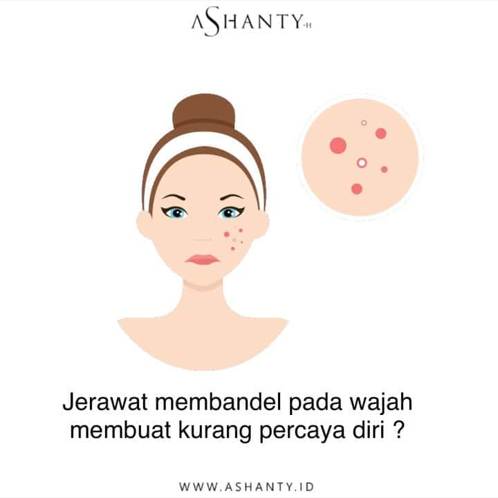 ASHANTY BEAUTY CREAM OFFICIALのインスタグラム：「Jerawat membandel pada wajah membuat kurang percaya diri?  Ladies, kamu tidak perlu khawatir gunakan Ashanty Beauty Cream Acne Series yang mampu membantu mengatasi jerawat membandel pada wajah, mencerahakan wajah, melembutkan, melembabkan dan membuat wajah lebih bersih berseri 🌸  _____________________________ Informasi dan pemesanan  Ashanty Beauty Cream Chat Via WA : WA: 081287388885 WA: 085781140354 WA: 087778489900 WA: 081293823950 ⚡️ Fast Respons Click Link On Bio Instagram @ashantyid ❣️ ______________________________ #ashantybeautycream #creamashanty #skincareashanty #skincare #skincareartis #skincarelokal #creamwajah #creamperawatanwajah #obatjerawat #jerawat #kosmetik #krimwajah #creamwajah #whiteningcream #ashantyid #ashanty」