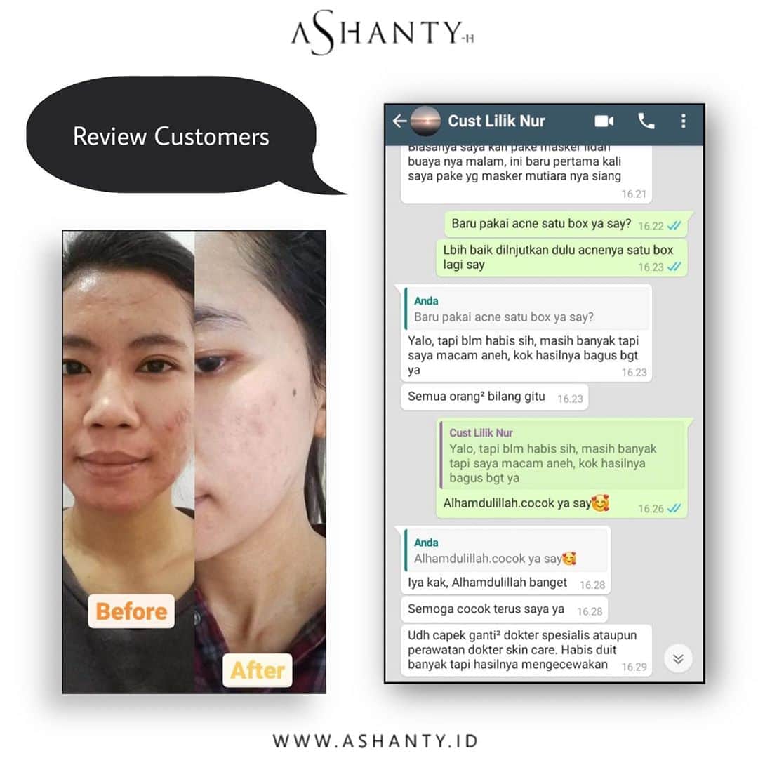 ASHANTY BEAUTY CREAM OFFICIALのインスタグラム：「Review setelah menggunakan Ashanty Beauty Cosmetics Acne Series 😍  Kulit wajah semakin bersih dari jerawat dan lebih cerah ✨  _____________________________ Informasi dan pemesanan  Ashanty Beauty Cream Chat Via WA : WA: 081293823950 WA: 081287388885 WA: 087778489900 WA: 085781140354 ⚡️ Fast Respons Click Link On Bio Instagram @ashantyid ❣️ ______________________________ #ashantybeautycream #creamashanty #skincareashanty #skincare #skincareartis #skincarelokal #creamwajah #creamperawatanwajah #obatjerawat #jerawat #kosmetik #krimwajah #creamwajah #whiteningcream #ashantyid #ashanty」