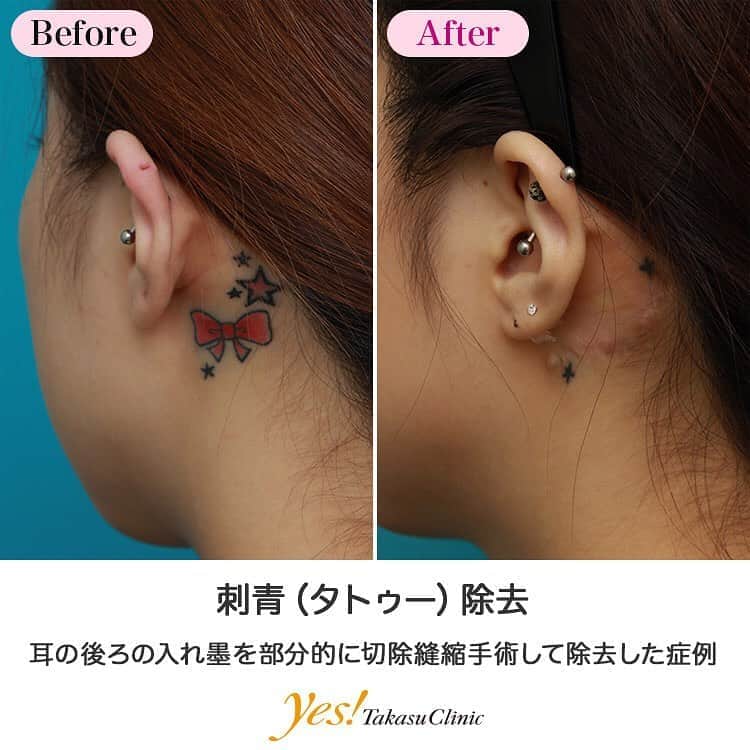 高須クリニックのインスタグラム：「👨🏻‍⚕️高須幹弥医師からのコメント✨⠀ 20代女性の患者様で、耳の後ろに入れた入れ墨を消したいという御要望で来院されました。 入れ墨を入れたことを後悔して消したいのではなく、入れた入れ墨のデザインが気に入らないので、消して入れ直したいということでした。 一番上と一番下の星を残して、残りの入れ墨を除去したいということでしたので、御要望通りに切除縫縮しました。 6ヶ月後には傷がだいぶ軟らかくなって落ち着いたので、また入れ墨を入れ直すことが可能です。 ---------------------------------------------------- 🌈料金✨⠀ ●刺青（タトゥー）除去（レーザー） 1cm×1cm ¥10,000 / 線状の入れ墨の場合　1cm ¥10,000【全院】 ●刺青（タトゥー）除去（切除縫縮） 顔面以外の入れ墨を単純に縫合する場合の目安　1cm ¥25,000【東京、横浜、名古屋、大阪】 ※また、単純に直線で縫合するのではなく、複雑な手術になる場合は料金が割増になります。 ●刺青（タトゥー）除去（剥削） ハガキ大サイズ ¥500,000【東京、横浜、名古屋、大阪】 ●刺青（タトゥー）除去（皮膚移植） ハガキ大サイズ ¥600,000【東京、横浜、名古屋、大阪】 ---------------------------------------------------- ⚠️リスク・副作用・合併症✨⠀ ●刺青（タトゥー）除去 完全に除去しきれない（黒や青以外の入れ墨の場合） 手術後に処方する抗生剤や痛みどめによるアレルギー症状 傷跡が肥厚性瘢痕やケロイドになる可能性（切除縫縮手術） 傷跡が肥厚性瘢痕やケロイドになる可能性（剥削手術） 手術後の血腫 --------------------------------------------------- 😊施術についての詳細✨⠀⠀ https://www.takasu.co.jp/photo/irezumi34.html ---------------------------------------------------- 📞ご予約・お問い合わせ✨⠀ 0120-5587-10⠀ https://www.takasu.co.jp/cgi-bin/form/contact.cgi ※症例写真や施術に関するご質問なども上記までお願い致します。 ---------------------------------------------------- #タトゥー #入れ墨 #刺青 #タトゥー除去 #入れ墨除去 #刺青除去 #タトゥーを消したい #タトゥーを入れ直したい  #皮膚 #美容 #美肌 #エイジングケア #美容整形 #美容外科 #美容クリニック #美容好き #美容皮膚科 #モニター #モニター募集 #高須クリニック #高須クリニック名古屋 #高須幹弥 #整形したい #プチ整形 #症例 #症例写真 #可愛くなりたい #可愛い #美人」