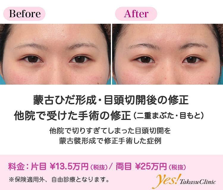 高須クリニックのインスタグラム：「👨🏻‍⚕️高須幹弥医師からのコメント✨⠀ 20代女性の患者様で、6ヶ月以上前に他院で目頭切開を受けていました。 蒙古襞形成を希望されていました。 診察させていただいたところ、他院で受けた目頭切開の術式は不明なのですが（おそらくZ法に準じた術式だと思われる）、やや切り過ぎな感があり、寄り目になってキツい印象になっていました。 カウンセリングでコンピューターシミュレーションをしながら患者様とお話しした結果、逆Z法による蒙古襞形成手術で約1.5mmずつ目頭を戻すことになりました。 手術は局所麻酔下に行い、程よく目頭側の粘膜を隠すようにしました。 手術後は、自然な蒙古襞が形成され、キツい印象はなくなりました。 また、修正手術前にあった外斜視っぽい印象も改善しました。 ---------------------------------------------------- 🌈料金✨⠀ ●蒙古ひだ形成・目頭切開後の修正 片目 ¥135,000 / 両目 ¥250,000【東京、横浜、名古屋、大阪】 ---------------------------------------------------- ⚠️リスク・副作用・合併症✨⠀ ●蒙古ひだ（蒙古襞）形成・目頭切開後の修正 内出血（術後） 仕上がりのわずかな左右差（完璧なシンメトリーは不可） 仕上がりが完璧に自分の理想の形にならないことがある --------------------------------------------------- 😊施術についての詳細✨⠀⠀ https://www.takasu.co.jp/photo/hida010.html ---------------------------------------------------- 📞ご予約・お問い合わせ✨⠀ 0120-5587-10⠀ https://www.takasu.co.jp/cgi-bin/form/contact.cgi ※症例写真や施術に関するご質問なども上記までお願い致します。 ---------------------------------------------------- #蒙古ひだ形成 #目頭切開後の修正 #他院で受けた手術の修正  #皮膚 #美容 #美肌 #エイジングケア #美容整形 #美容外科 #美容クリニック #美容好き #美容皮膚科 #モニター #モニター募集 #高須クリニック #高須クリニック名古屋 #高須幹弥 #整形したい #プチ整形 #症例 #症例写真 #可愛くなりたい #可愛い #美人」