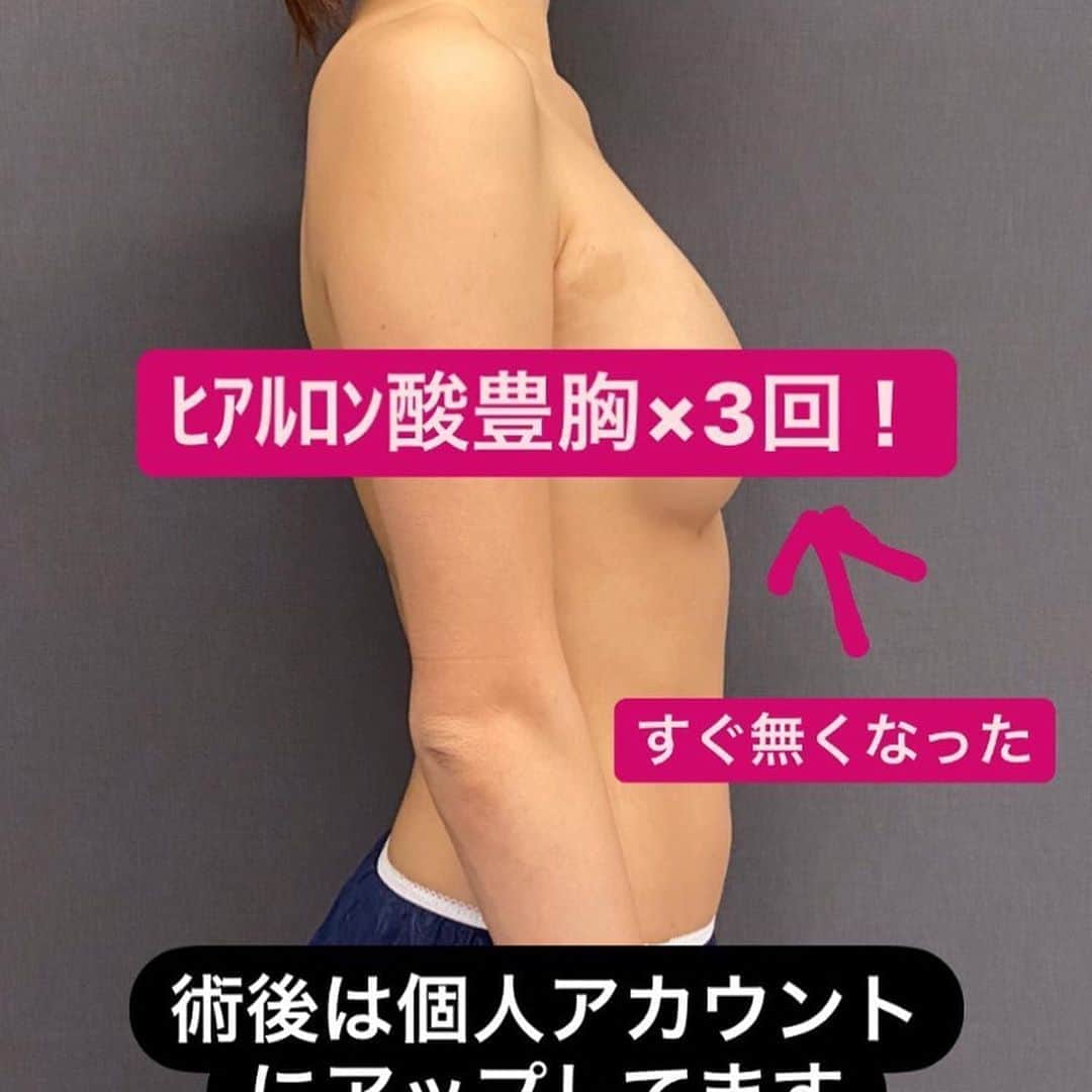 東京美容外科公式のインスタグラム：「#Repost @tkc110 with @make_repost ・・・ ヒアルロン酸豊胸自体を否定するつもりはないので、、 言いたいことは個人アカウントに書きました。 個人の意見としてw 修正術後の写真もそちらです。 #小野准平 #シリコン豊胸 #ヒアルロン酸豊胸 #バストアップ #ボディメイク #ベストボディ #新宿 #歌舞伎町 #キャバクラ #キャバ嬢 #クラブ #ホステス #ギャル #ダンサー #ビキニ」