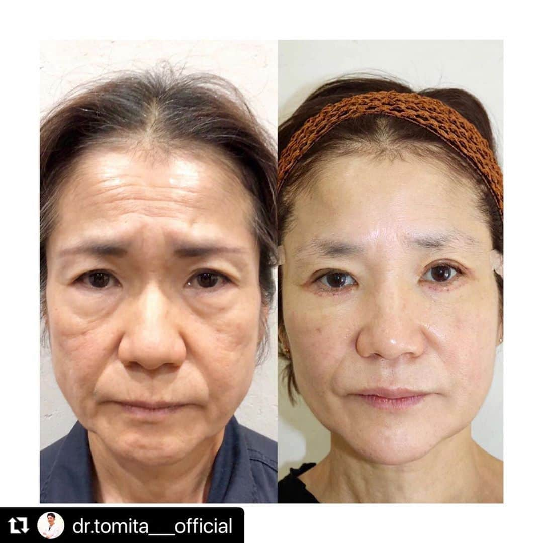 東京美容外科公式さんのインスタグラム写真 - (東京美容外科公式Instagram)「#Repost @dr.tomita___official with @make_repost ・・・ . 【究極のアンチエイジング】 〜〜 Anti-aging  Series 1〜〜  お久しぶりの投稿です😉 皆さま、ご無沙汰しておりました！ といってもサボってたわけではありませんで、手術や出張、セミナー(ライブサージャリー担当)、TV取材等もありバタバタとしておりました🤣  さて💡、今回の患者様は"若返り(anti-aging)"を求めて当院にいらして下さいました。  これまで家事に、育児にと、とてもお忙しくされたとのことで、一段落してマジマジとお顔を見たら皺やタルミといった"愛の勲章🌹"だらけ。  手術の時にご家族の方もいらしてて、とても愛されたお母様だなという印象を受けました✨  でも、やっぱり…その皺やタルミはどうしても加齢感に繋がって見えてしまいます。 それは化粧品では、もう誤魔化せないほど。  どこから手を付ければ良いのかというところが正直なところですが、外科医として腕が鳴るところです。  まずは、施術前後のお写真を供覧しましょう🌟  図らずも彼女は一気に時計の針を巻き戻したいとのことを申しあげて頂きまして、1日でお顔全ての治療を行いました！！ 施術後のお写真は手術から1週間後のお写真です。  それでは次回、Problem listを挙げて詳しく見て行きましょう🙂  //////////////////////////////////////////////////////////////////////////////////////////////////////////////////////////////////////////////////////  ＊御本人に掲載確認を得ております。 掲載を快くご了承頂きまして、深く心より感謝申し上げます。  🌹当院が選ばれる理由 ✔︎豊富な症例数 ✔︎安心感のあるスタッフ、施術環境 ✔︎麻酔科専門医による安全麻酔 ✔︎丁寧なカウンセリング ✔︎形成外科専門医ならではの確かな技術🥼 ✔︎ナチュラルな仕上がり✨ ✔︎リピーターさん続出、ご紹介も多いです ✔︎大切なあなたの為に真剣に取り組みます  🏅東京美容外科ブランド🏅 それは修練を受けた医師だけが施術を認められる組織。 ピリッと背筋を伸ばして、治療にあたっております。 最善の結果を追及する気持ちが、より良い結界に繋がると信じてます。  💡あなたのお悩みに全力で対応します。 でも、どんな治療でもお引き受けする訳ではありません。ご希望の治療が、お客様に不利益であると判断した際にはお断りすることもあります。 . . . . ご予約/お問い合わせは ☎️ 0120-658-958 . . . . . #冨田壮一 #東京美容外科銀座院 #東京美容外科 #形成外科専門医 #美容好きな人と繋がりたい  #二重 #ZOskin #美容 #美容整形 #アンチエイジング #anti-aging #シワ治療 #美容外科 #シリコンバッグ豊胸 #instagram  #しわ #photoofday  #doctor #フェイスリフト #facelift #眼瞼下垂 #クマ治療 #美人 #女子大生 #ヒアルロン酸 #ボトックス #クラブ  #銀座 #北新地」10月25日 15時14分 - tokyobiyougeka_jimukyoku