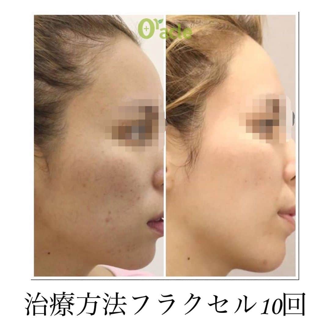 オラクル美容皮膚科東京新宿院さんのインスタグラム写真 - (オラクル美容皮膚科東京新宿院Instagram)「﻿ 📝ニキビ症例ご紹介﻿ オラクル美容皮膚科ではニキビ治療に特化した施術を多数ご用意しております。﻿ ﻿ 繰り返すニキビやなかなか消えないニキビ跡、、、さらにマスク生活でニキビができやすい環境です😭﻿ ﻿ オラクルのニキビ治療メニュー﻿ ⇩⇩⇩﻿ 🔴アグネス﻿ 効果⇒皮脂腺を直接破壊⚡くりかえすニキビに有効な施術です。﻿ 料金⇒[片側]顎・頬・こめかみ/[1か所]鼻　1回20,000円(税抜)﻿ ﻿ 🔵BHAピーリング﻿ 効果➡サリチル酸を使用したピーリング。ニキビができにくい肌へ改善をしてくれます✨﻿ 料金➡1回10,000円(税抜)﻿ ﻿ 🔴フラクセル﻿ 効果➡お肌に小さな傷をつけることで、それを修繕しようとする自然治癒力の働きで新しい肌へリセットさせる施術。ニキビ跡や凸凹肌に！﻿ 料金➡顔全体1回19,800円(税抜)﻿ ﻿ ﻿ ﻿ オラクル美容皮膚科ではニキビの症状にあった施術をご提案させていただきます💁﻿ ニキビでお悩みの方はお気軽にご相談ください😊﻿ ﻿ ▪️▫️▪️▫️▪️▫️▪️▫️▪️▫️﻿ ﻿ 🇯🇵オラクル美容皮膚科🇰🇷﻿ 📍東京新宿院﻿ 新宿3丁目19-4 MLJ新宿8階﻿ ﻿ 📍名古屋院﻿ 名古屋市中区錦3丁目24-4﻿ サンシャイン栄5階﻿ ﻿ 【専門】﻿ ニキビ（跡）／毛穴／シミ／しわ／たるみ／痩身／アンチエイジング／美白美肌治療全般／ブライダル相談／メンズ美容﻿ ﻿ 🗝完全予約制﻿ 👠土日祝日も診療﻿ ﻿ 【予約方法】﻿ ☎0120-905-696﻿ ⏰9:00～21:00［年中無休］﻿ ﻿ LINE、メール24時間📧﻿ LINE🆔 @oracle.jp ﻿ 📩HPメールフォームよりお願いいたします﻿ ﻿ ﻿ ▪️▫️▪️▫️▪️▫️▪️▫️▪️▫️﻿ ﻿ #オラクル美容皮膚科 #オラクル ﻿ #oracle #韓国美容 #美容皮膚科 ﻿ #皮膚科 #美容 #小顔矯正 #コラーゲン #美容オタク #美容マニア  #ヒアルロン酸 #弾力 #ハリ #美白 #ピーリング #レーザー治療 #일본피부과 #오라클피부과 #ニキビ肌改善 #ニキビ跡ケア #美肌 #美肌ケア #肌管理 #韓国美容皮膚科 #ニキビ改善 #ニキビ跡 #ニキビケア #ニキビ #美容」10月26日 15時16分 - oraclejp