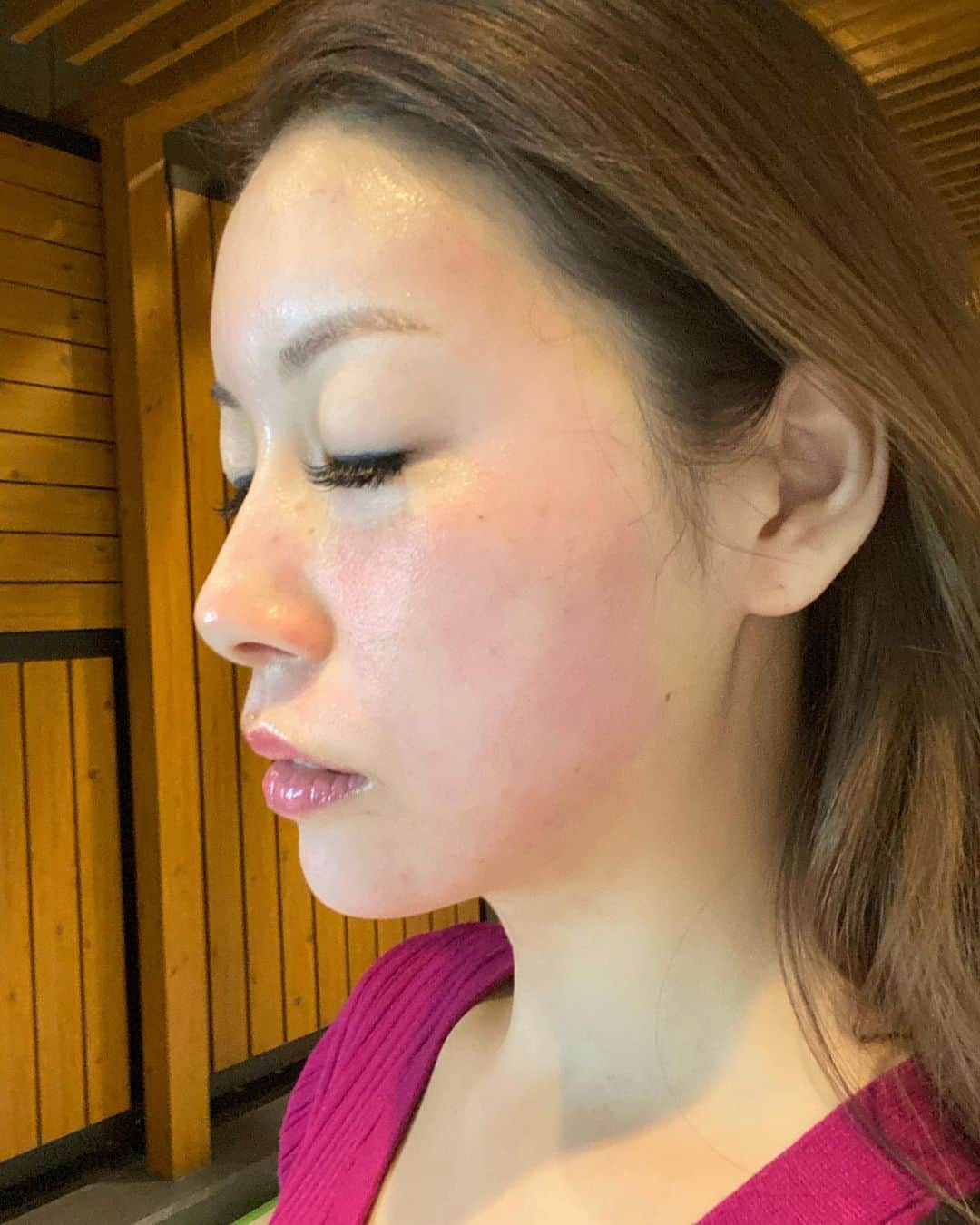 美沙さんのインスタグラム写真 - (美沙Instagram)「お肌のお手入れはエステ派な私💆‍♀️ なぜかって？ 痛いのもダウンタイムも嫌だから🙊 . っていうのを箱田先生に言ったら、痛みもダウンタイムも最小限で即効性もあるダーマペンをオススメしてもらったのでビクビク震えながら行ってきました😂 . 表面麻酔も人より長くおいて、針の長さも短め！ 今回は一緒に美容液も入れてもらったよ✨ その人のお肌の状況やお悩みによって美容液は選んでもらった方が良きです🙌 さらに最後パックまで！ . 結果、 ほんとに全然痛くなかった！ 私はこめかみのとこが少し痛かったかな。 終わった後は目の下赤かった！ 3日くらい赤いって言われたけど私は次の日には赤みひいてダウンタイム短めでした！ あくまでも私の結果やけど🙄 . でもねー めっちゃ綺麗になったの🥰 私の悩みは毛穴だったんだけど、毛穴小さくなった気がするからしばらく続けてみよっと🥰 . しかも11月は初回ダーマペンとか回数券の麻酔サービスとか美容液のキャンペーンとかあるから💸笑 しばらく箱田先生にお世話になろーっと🥰 . 写真は、 1.2枚目は全開アプリ🤣 3枚目はノーマルカメラ 4枚目は麻酔中 5枚目はダーマペン直後 6枚目は鎮静パック中 7枚目は全て終了後 8枚目は帰ってから！ 3枚目以降のノーマルカメラの苦情は受け付けません😇 顔長いしこけてるよね😇 わかってる😇 . #モデナクリニック #modenaclinic #ダーマペン #サイトケア532 #箱田美菜 #福岡大名 . @dr_hakodaharuna @dr.miyatani @modenaclini」10月26日 17時14分 - misa0623r