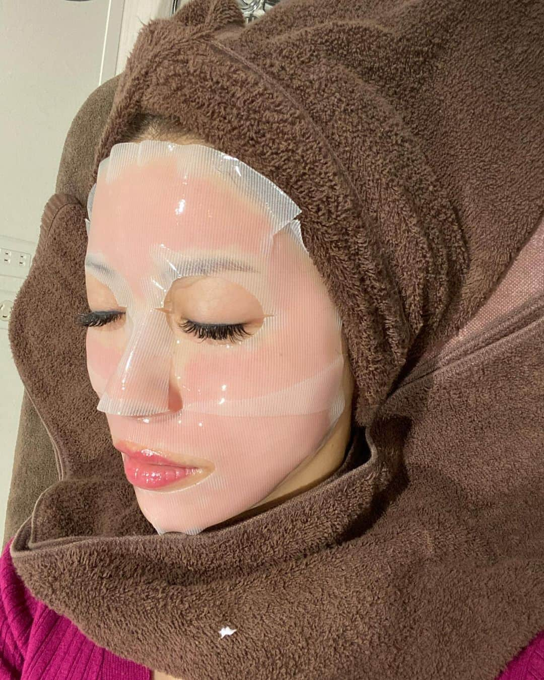 美沙さんのインスタグラム写真 - (美沙Instagram)「お肌のお手入れはエステ派な私💆‍♀️ なぜかって？ 痛いのもダウンタイムも嫌だから🙊 . っていうのを箱田先生に言ったら、痛みもダウンタイムも最小限で即効性もあるダーマペンをオススメしてもらったのでビクビク震えながら行ってきました😂 . 表面麻酔も人より長くおいて、針の長さも短め！ 今回は一緒に美容液も入れてもらったよ✨ その人のお肌の状況やお悩みによって美容液は選んでもらった方が良きです🙌 さらに最後パックまで！ . 結果、 ほんとに全然痛くなかった！ 私はこめかみのとこが少し痛かったかな。 終わった後は目の下赤かった！ 3日くらい赤いって言われたけど私は次の日には赤みひいてダウンタイム短めでした！ あくまでも私の結果やけど🙄 . でもねー めっちゃ綺麗になったの🥰 私の悩みは毛穴だったんだけど、毛穴小さくなった気がするからしばらく続けてみよっと🥰 . しかも11月は初回ダーマペンとか回数券の麻酔サービスとか美容液のキャンペーンとかあるから💸笑 しばらく箱田先生にお世話になろーっと🥰 . 写真は、 1.2枚目は全開アプリ🤣 3枚目はノーマルカメラ 4枚目は麻酔中 5枚目はダーマペン直後 6枚目は鎮静パック中 7枚目は全て終了後 8枚目は帰ってから！ 3枚目以降のノーマルカメラの苦情は受け付けません😇 顔長いしこけてるよね😇 わかってる😇 . #モデナクリニック #modenaclinic #ダーマペン #サイトケア532 #箱田美菜 #福岡大名 . @dr_hakodaharuna @dr.miyatani @modenaclini」10月26日 17時14分 - misa0623r