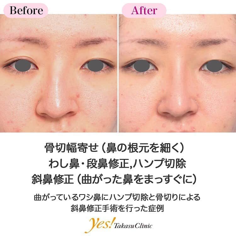 高須クリニックのインスタグラム：「👨🏻‍⚕️高須幹弥医師からのコメント✨⠀ 20代女性の患者様で、鼻が曲がっていることと、ワシ鼻であることが悩みで来院されました。 鼻が曲がっている原因は、成長と共に自然に曲がったのか、幼少時に鼻骨骨折したのか、はっきり分かりませんでした。 鼻の骨と軟骨の両方が大きく曲がっており、尚且つ骨は土台が曲がっているので、骨切り手術を行っても完全な真っ直ぐな鼻にすることはできませんが、骨切り手術でできる限り真っ直ぐに近づけることになりました。 また、ワシ鼻に関してはハンプ切除手術で、出っ張っている骨と軟骨を除去することになりました。 手術は局所麻酔下に、鼻の穴の中から手術を行い、ギプスで1週間固定しました。 術後は、多少の曲がりはありますが、術前に比べるとだいぶ真っ直ぐな鼻になりました。 ワシ鼻に関しては、出っ張っていた部分がなくなったなめ、横から見てほぼ真っ直ぐな鼻になりました。 ---------------------------------------------------- 🌈料金✨⠀ ●わし鼻・段鼻修正,ハンプ切除 ハンプ切除　手術 ¥400,000【東京、横浜、名古屋、大阪】 / シリコンプロテーゼ挿入 ¥350,000【東京、横浜、名古屋、大阪】 / ヒアルロン酸 ¥50,000【全院】 / 長期持続型ヒアルロン酸注射 ¥150,000【全院】 ●骨切幅寄せ（鼻の根元を細く） ¥600,000【東京、横浜、名古屋、大阪】 ●斜鼻修正（曲がった鼻をまっすぐに） 斜鼻修正　手術 ¥600,000【東京、横浜、名古屋、大阪】 / シリコンプロテーゼ挿入 ¥350,000【東京、横浜、名古屋、大阪】 / ヒアルロン酸 ¥50,000【全院】 / 長期持続型ヒアルロン酸 ¥150,000【全院】 ---------------------------------------------------- ⚠️リスク・副作用・合併症✨⠀ ●わし鼻・段鼻修正,ハンプ切除 内出血（注射針が血管に当たってしまった場合） 鼻が横に大きく広がって見える（元々鼻が横に広がっている人の場合） 仕上がりのわずかな左右差（完璧なシンメトリーは不可） 仕上がりが完璧に自分の理想の形にならないことがある 過度にいじったり揉んだりすると腫れる可能性 ●骨切幅寄せ（鼻の根元を細く） 鼻ギプスがマスクで隠しきれない／目や鼻周辺の腫れ（術後） 腫れ・内出血（術後） 仕上がりのわずかな左右差（完璧なシンメトリーは不可） 仕上がりが完璧に自分の理想の形にならないことがある ギプス固定による褥瘡 ●斜鼻修正（曲がった鼻をまっすぐに） 鼻ギプスがマスクで隠しきれない／目や鼻周辺の腫れ（術後） 目や鼻周辺の腫れ・内出血（術後） 内出血（注射針が血管に当たってしまった場合） 仕上がりのわずかな左右差（完璧なシンメトリーは不可） 過度にいじったり揉んだりすると腫れる可能性 --------------------------------------------------- 😊施術についての詳細✨⠀⠀ https://www.takasu.co.jp/photo/hump17.html ---------------------------------------------------- 📞ご予約・お問い合わせ✨⠀ 0120-5587-10⠀ https://www.takasu.co.jp/cgi-bin/form/contact.cgi ※症例写真や施術に関するご質問なども上記までお願い致します。 ---------------------------------------------------- #骨切幅寄せ #鼻の根元を細く #わし鼻 #段鼻修正 #ハンプ切除 #斜鼻修正 #曲がった鼻をまっすぐに #鼻整形  #皮膚 #美容 #美肌 #エイジングケア #美容整形 #美容外科 #美容クリニック #美容好き #美容皮膚科 #モニター #モニター募集 #高須クリニック #高須クリニック名古屋 #高須幹弥 #整形したい #プチ整形 #症例 #症例写真 #可愛くなりたい #可愛い #美人」