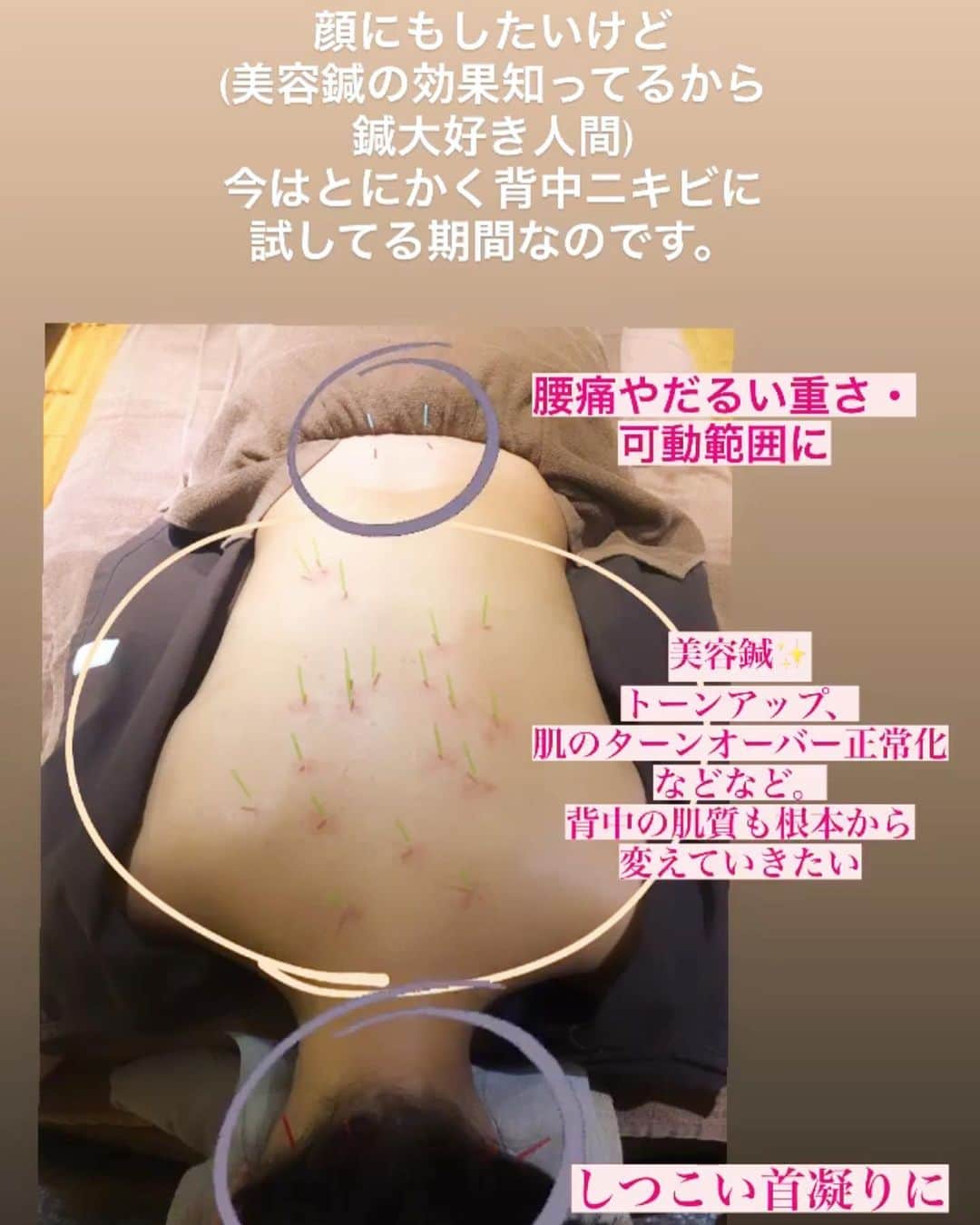 藤森マリナさんのインスタグラム写真 - (藤森マリナInstagram)「後ろ姿も綺麗な人になる💛 * * 年々女性として 見られたいところが変わってきて？ 増えて？ ケアするところも増えて 大変ですが楽しんで 頑張ってるまりなはんです😌💭 * * このスタイルシンプルに見えるけど 実は後ろが#紐アレンジ で めためた可愛いの🥺♥️ そして花嫁といえば背中！！ だからこの撮影の前日には 信頼している美容鍼で 継続して頑張ってる背中ケアを してきたよ✊🏻💨 * * まだまだ新しいニキビもできちゃうし 昔の色素沈着もあるけど 三好先生に言われた通りに 保湿頑張ってたら 背中の肌質が変わってきた！！✨ 長い道のりかもしれないけど ツルツル背中目指して 鍼と保湿ケアをもう少し 頑張っていきます🔥 * * ついでに三好先生は 本当に素晴らしい技術をお持ちで 触診にも自信がある！！ って先生自身が言ってくれたれ こちらも安心して任せられるし 首凝り、腰痛、姿勢の悩みとかも 鍼治療で緩和させられたり 仕事で疲れてる男性諸君の皆様には 是非ここの美顔ジムもおすすめしたい♡ ジムと書いてるけど あなたは寝転がってるだけです😂 ほんまにこのあたまへの電流は 新感覚やしめっちゃスッキリするから 是非受けて欲しい！！ まりなはんのインスタ見たでもいいし 何かしら常にキャンペーンやってたりするから DMで問い合わせてみてね📩✨ * * ☑︎大阪院→ @mouton_shinkyu ☑︎東京院→ @acupa.salon ☑︎先生→ @miyoshi.hideaki」10月26日 19時15分 - maaarina0806