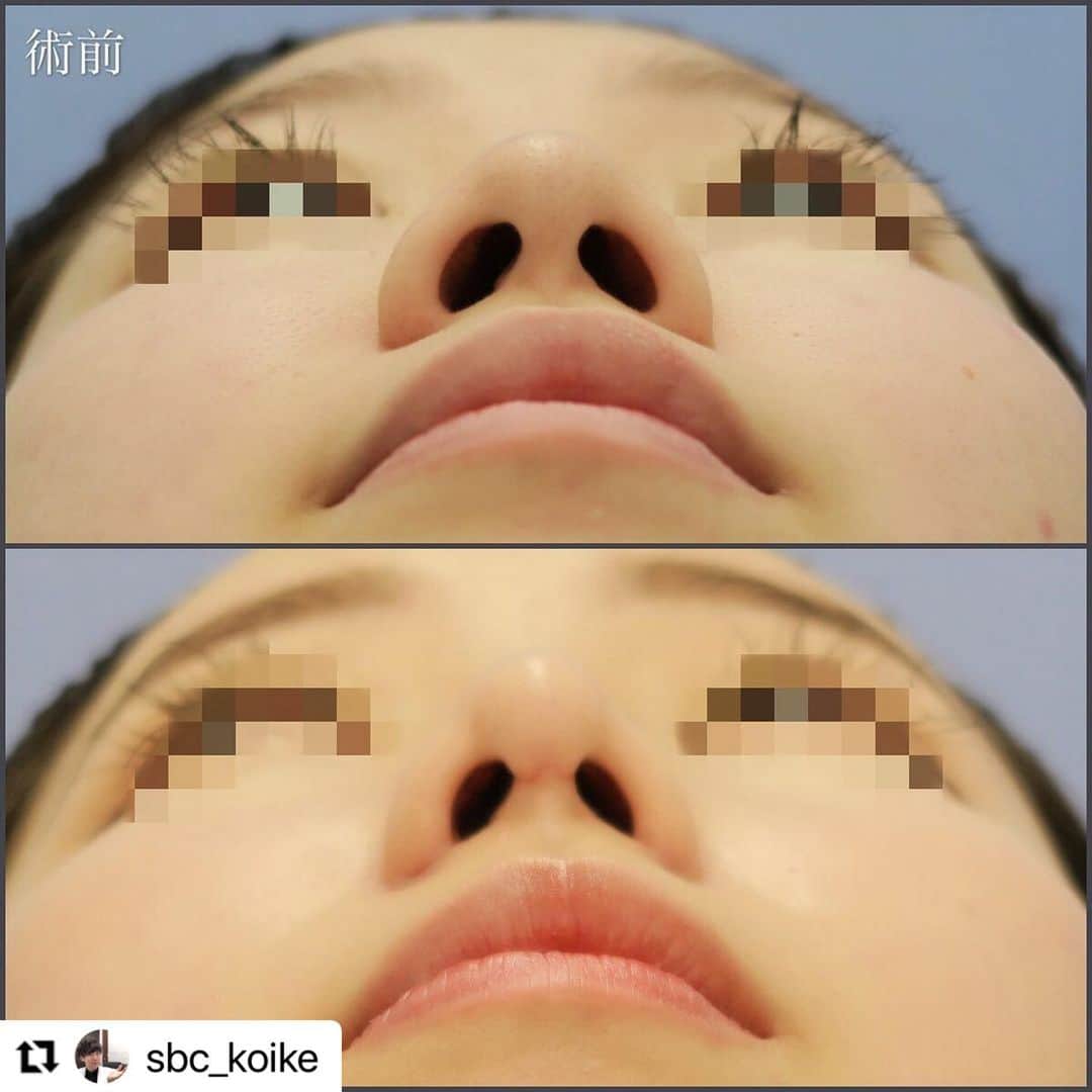 湘南美容外科 柏院さんのインスタグラム写真 - (湘南美容外科 柏院Instagram)「#Repost @sbc_koike with @make_repost ・・・ ■プロテーゼ＋だんご鼻修正(鼻尖形成3D法)＋耳軟骨移植＋小鼻縮小フラップ法による、小池式・韓流スマートノーズ🇰🇷 1ヶ月後 ・ 更に額の脂肪注入も行い、横顔から鼻にかけてのラインを整えています。  鼻筋の腫れは3ヶ月程度で治ります。  プロテーゼを挿入すると、鼻筋部分の腫れ感はすぐ目立たなくできます。 ・ ・ 鼻の変化は、小さなものでもお顔の印象は変わってきます。 ・ ・ しっかりとしたカウンセリングで理想の鼻を実現しましょう🔥  自分に合った施術がわからない方は、ぜひ一度カウンセリングにいらして下さいね  鼻のご相談は湘南美容外科クリニック🏥柏院院長の小池にご相談ください📞 ・  ※施術を受けたことにより、傷、内出血、腫れ、痛み、感染、左右差、麻酔によるアナフィラキシーが起こるリスクがあります。  #湘南美容クリニック #小池泰弘 #美容外科 #かわいい #柏 #千葉  #新宿 #渋谷 #韓流 #キャバ #整形 #鼻 #小鼻縮小 #団子鼻 #プロテーゼ #鼻尖形成 #鼻中隔延長 #切らない鼻中隔延長 #鼻整形 #韓流スマートノーズ #小池式鼻整形  #アイメッド #オンライン診療 #オンライン相談 #若返りたい人必見  #エイジングケア湘南  #たるみ改善湘南  #脱毛最安」11月24日 18時59分 - sbc_kashiwa