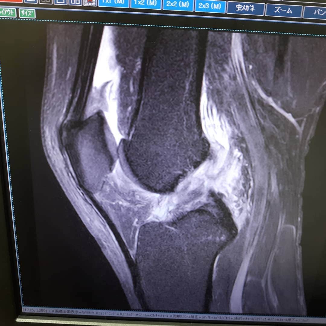金原弘光さんのインスタグラム写真 - (金原弘光Instagram)「先日のプロレスでやっぱり前十字靭帯断裂してた。あと内・外側靭帯損傷、半月板も損傷してた❗ 損傷なら治せるけど、断裂は手術しか方法がないよな‼⤵⤵ 17年前に右膝の手術して今回は左膝。  あ～あ。  筋肉強化でなんとかならないかなぁ～。」11月24日 22時03分 - hiromitsu.kanehara