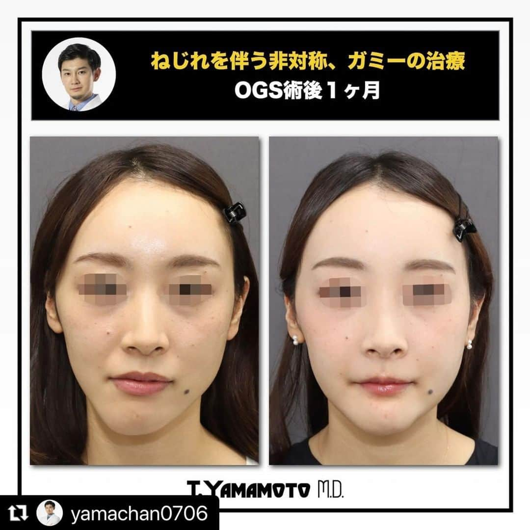 東京美容外科公式さんのインスタグラム写真 - (東京美容外科公式Instagram)「赤坂院副院長骨切り山ちゃんの劇的BeforeAfter✨ #Repost @yamachan0706 with @make_repost ・・・ ★★★ねじれを伴う複雑な非対称とガミースマイルを同時に治すOGS術後1ヶ月★★★ ★３Dシミュレーションで正確なポジション取りをすることで丁寧に治していく★  以前CTのお写真を出した患者様の術後経過になります。 ネジレを伴う複雑な非対称とガミースマイルの治療です。 矯正医とかみ合わせの位置を打ち合わせし、３Dシミュレーションできっちり真っ直ぐになるように丁寧に術中の顎の位置を決めていきます。  また少し長めのお顔をガミースマイルの改善と同時に治療しています。 最後にオトガイ形成を行うことでE-lineと非対称治療の画竜点睛としています。  こういう捻じれのある非対称の患者様は極めて3次元的に高度な骨移動の仕方になるため、３Dシミュレーションでの綿密な計画をたててくれるところでしか手術を受けては行けないと思います。  我々は、３Dシミュレーションで作成したデータを元に３Dプリンターで作成したマウスピースを用いることで実際の手術を正確に行えるような工夫を行っています。  非対称の治療というのは非常に奥深く、治療する私達としても非常にやりがいのある治療です。 非対称にお悩みの方は、お力になれるかもしれません。 是非一度ご相談ください。  /////////////////////////////////////////////////////////////////////////////////////////////////////  カウンセリングは東京美容外科のコールセンター、LINE予約などから受け付けております。 また、Webカウンセリングなどもぜひご利用ください。  /////////////////////////////////////////////////////////////////////////////////////////////////////  /////////////////////////////////////////////////////////////////////////////////////////////////////  ＜行った施術＞ Le Fort Ⅰ型骨切り＋SSRO+＋オトガイ形成（短縮、左方移動）＋Vライン形成  ＜リスク＞ 下口唇の痺れ プレート感染 後戻り 血腫、後出血 鼻閉 開口制限 咬合不正など  /////////////////////////////////////////////////////////////////////////////////////////////////////  #整形美人 #小顔美人 #小顔整形 #顔痩せ #外科矯正 #受け口 #下顎前突 #口元美人 #顎変形症 #ルフォー #東京美容外科 #顔面非対称 #輪郭手術 #輪郭整形 #整形垢さんと繋がりたい #美容垢さんと繋がりたい #両顎手術 #形成外科専門医 #骨切り山ちゃん #小顔になりたい #小顔美容矯正 #顔でかい #顔でか #顔やせ #eライン #赤坂 #整形したい #横顔美人 #横顔フェチ」11月21日 10時32分 - tokyobiyougeka_jimukyoku